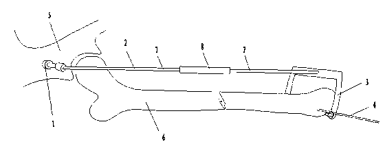 Femoral fracture traction apparatus with good reduction fixing effect