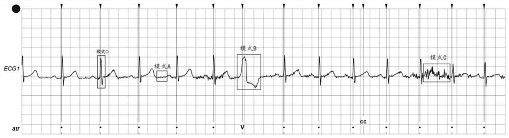 Electrocardiogram data compression method and device