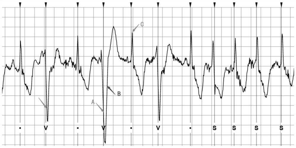 Electrocardiogram data compression method and device