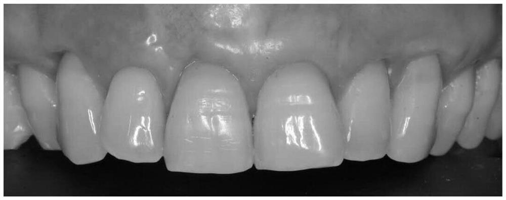 A kind of acellular allogeneic dermal matrix and its application in oral diseases