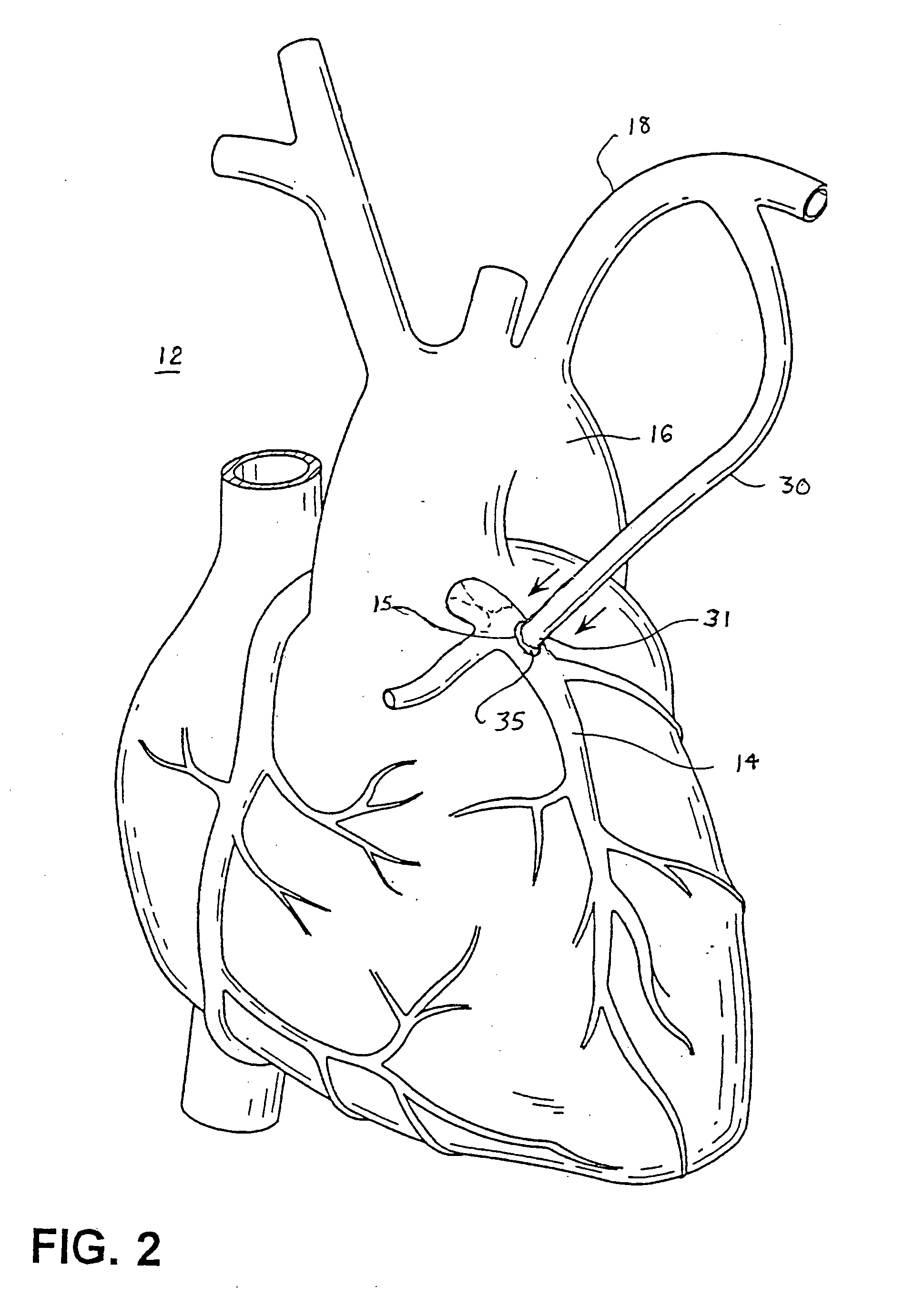 Electrosurgical methods and apparatus for making precise incisions in body vessels