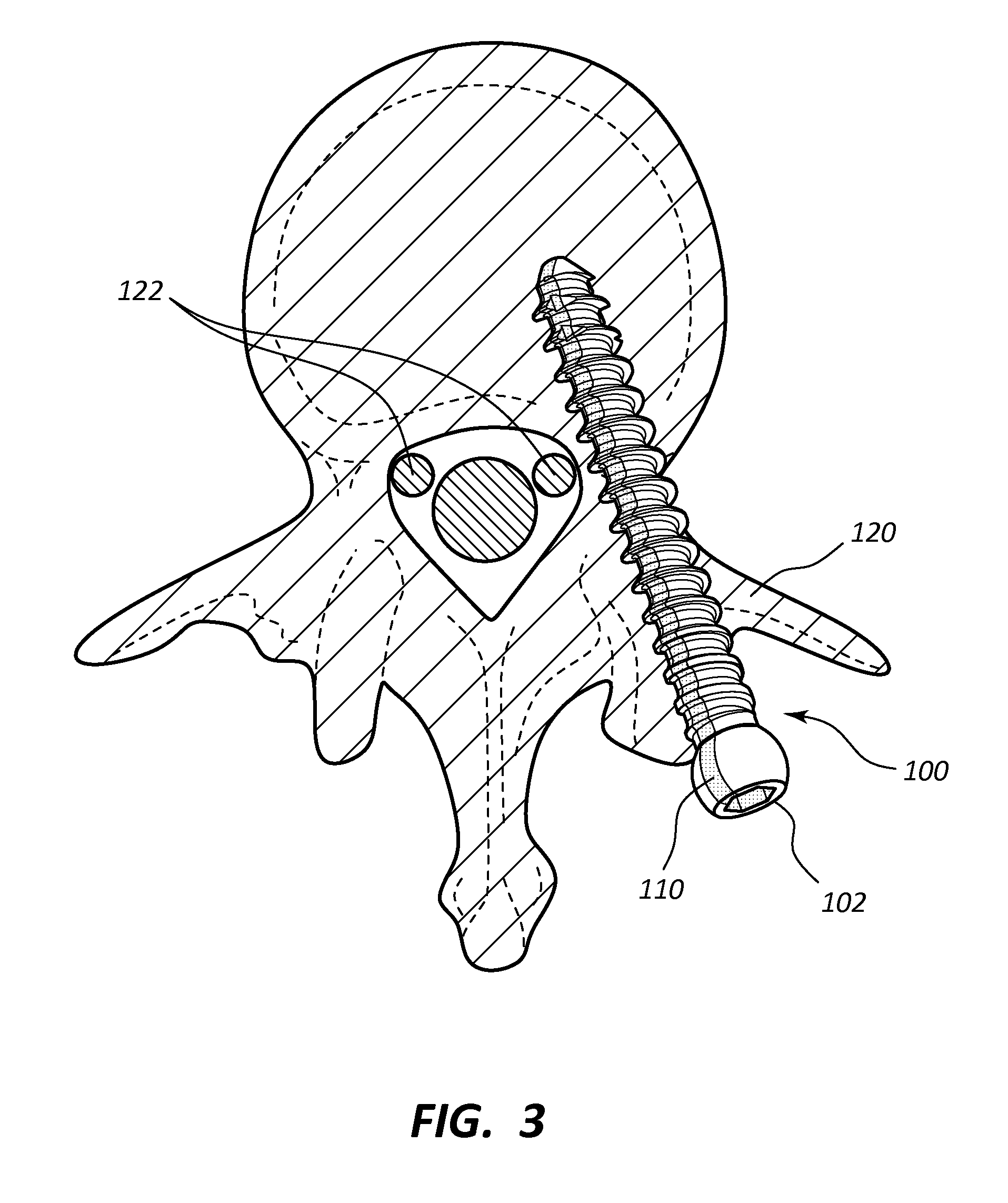 Pedicle screw with electro-conductive coating or portion