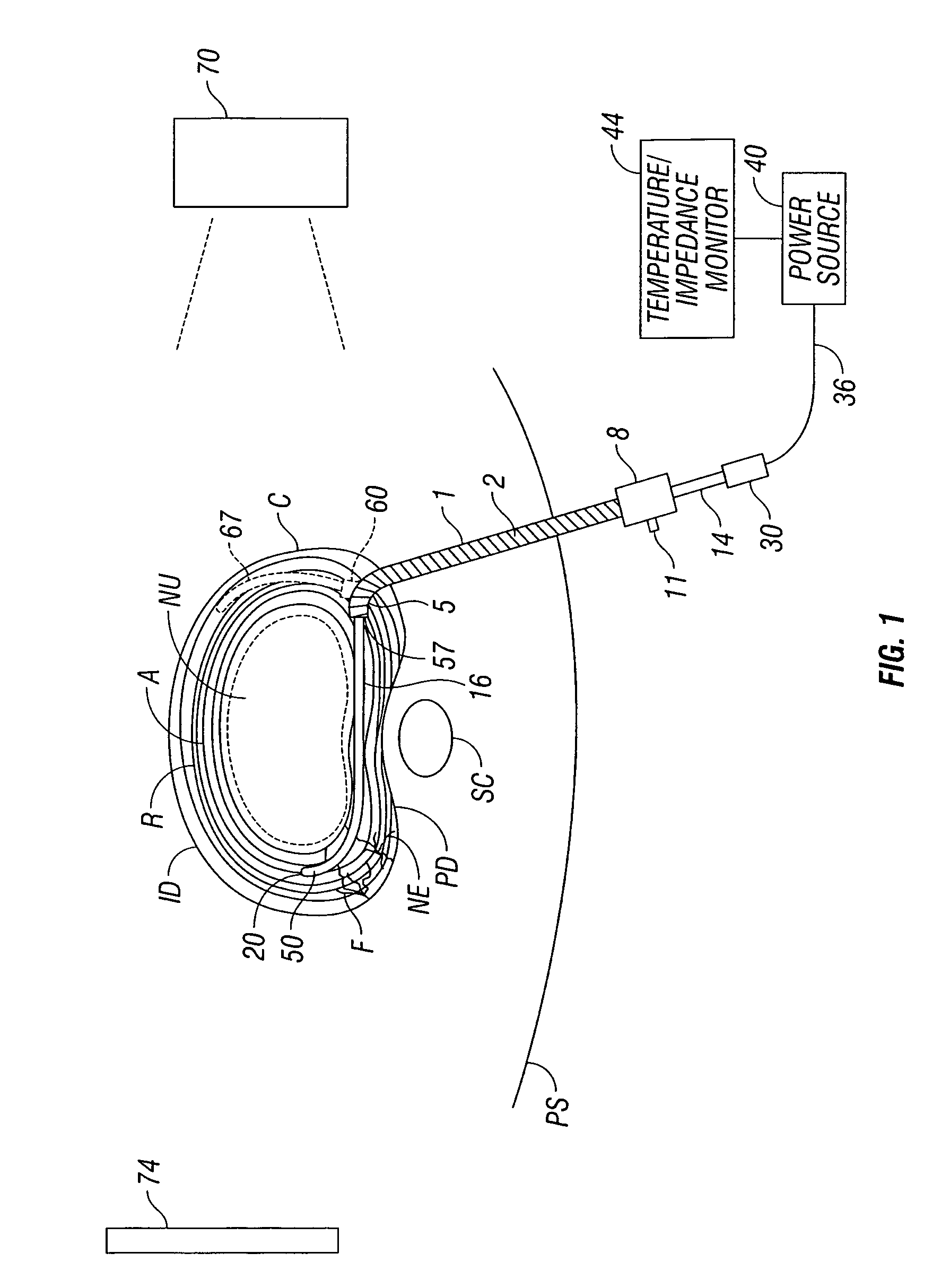 Apparatus for thermal treatment of an intervertebral disc