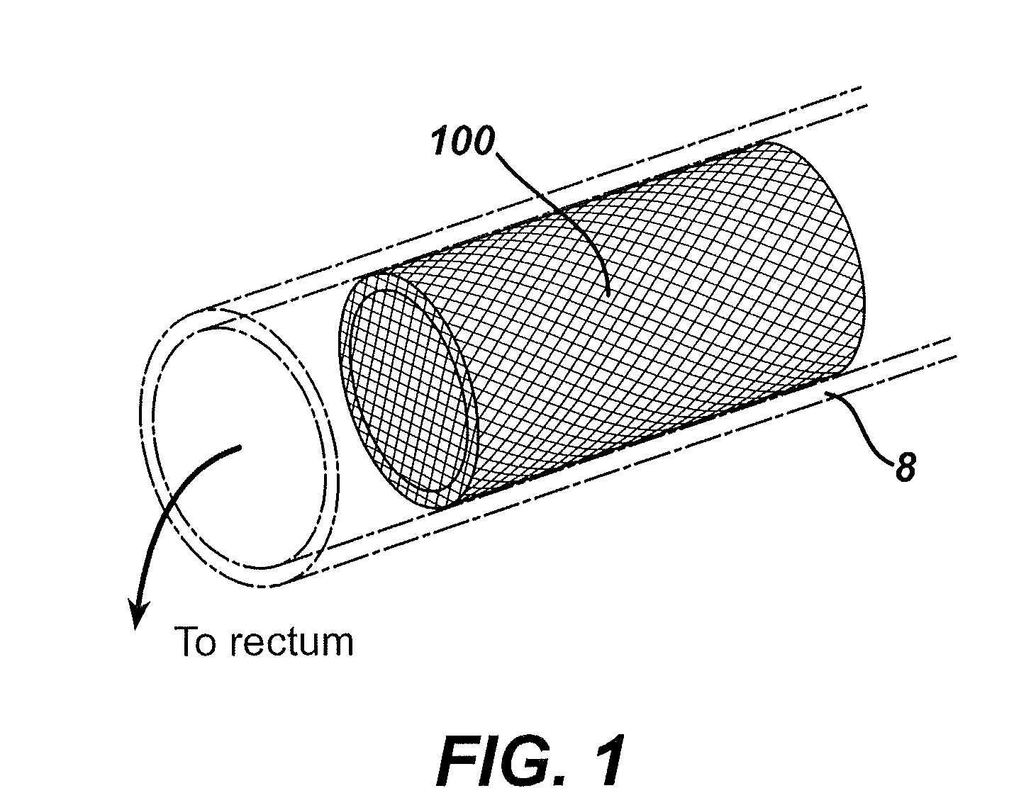 Intestinal brake inducing intraluminal therapeutic substance eluting devices and methods