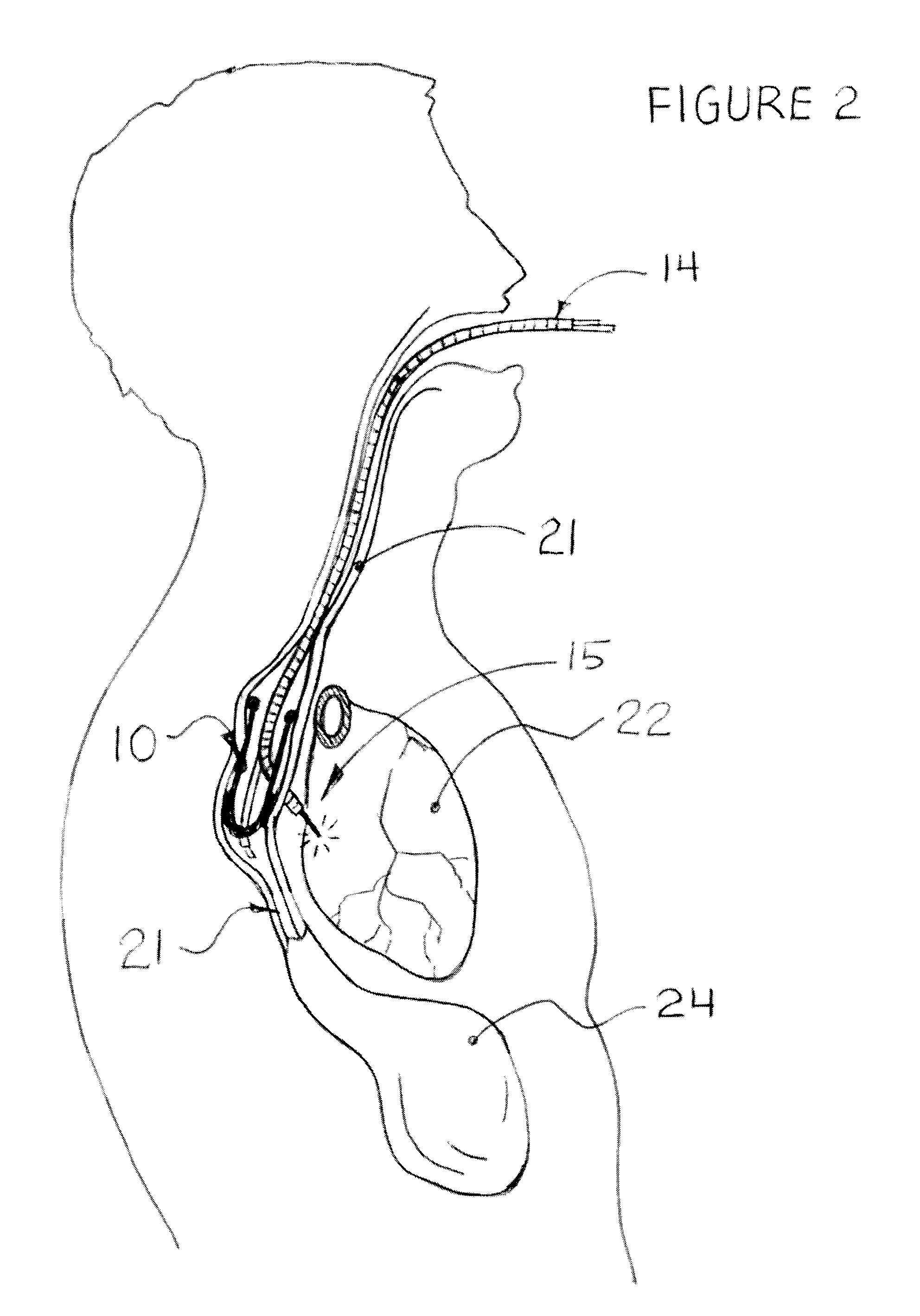 Methods and apparatus for transesophageal microaccess surgery