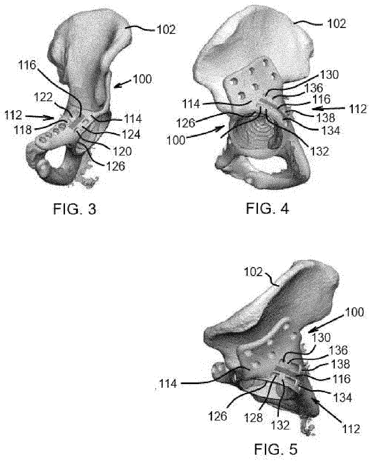 Systems and methods for attaching soft tissue to an implant