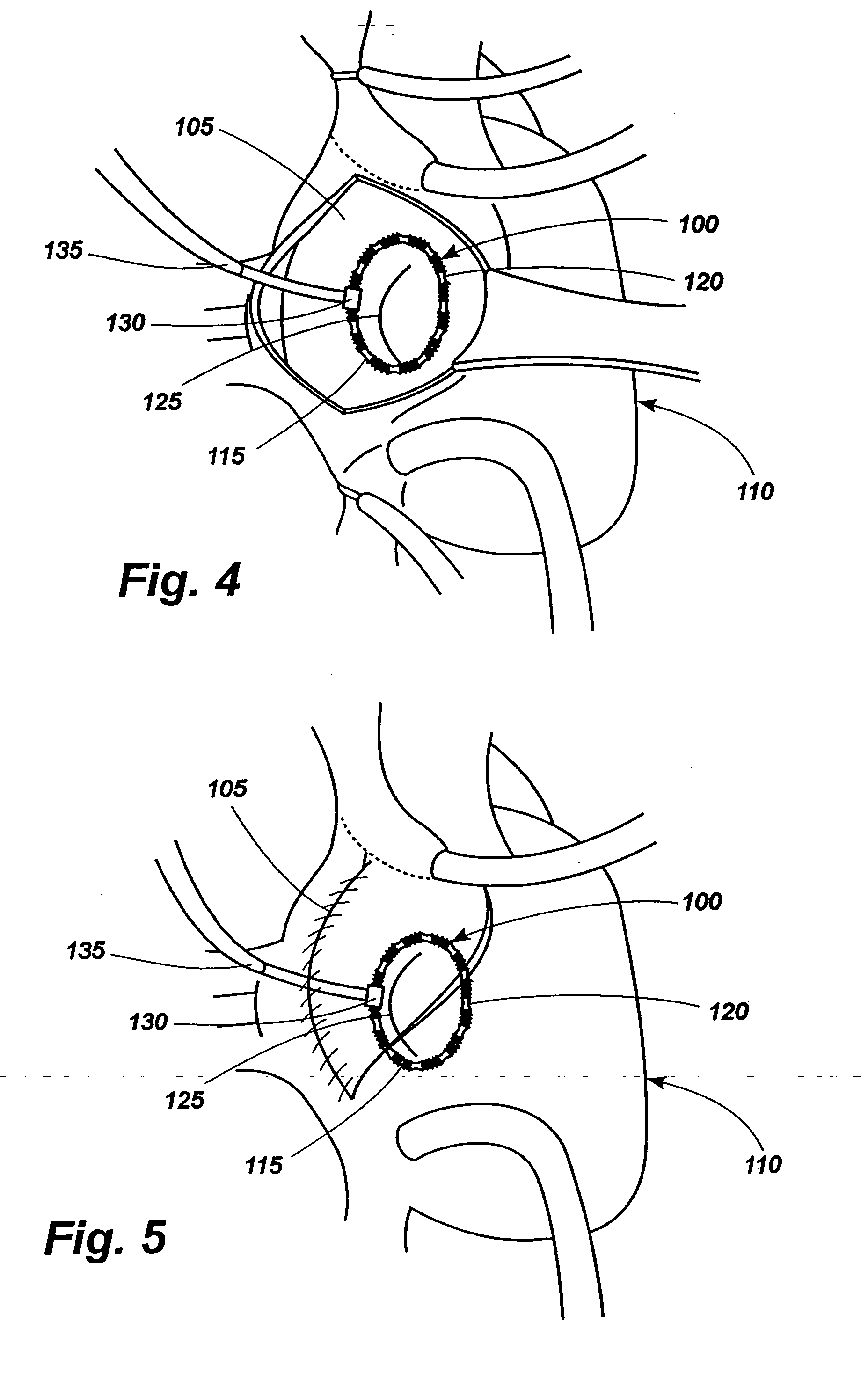 Apparatus for implanting surgical devices for controlling the internal circumference of an anatomic orifice or lumen