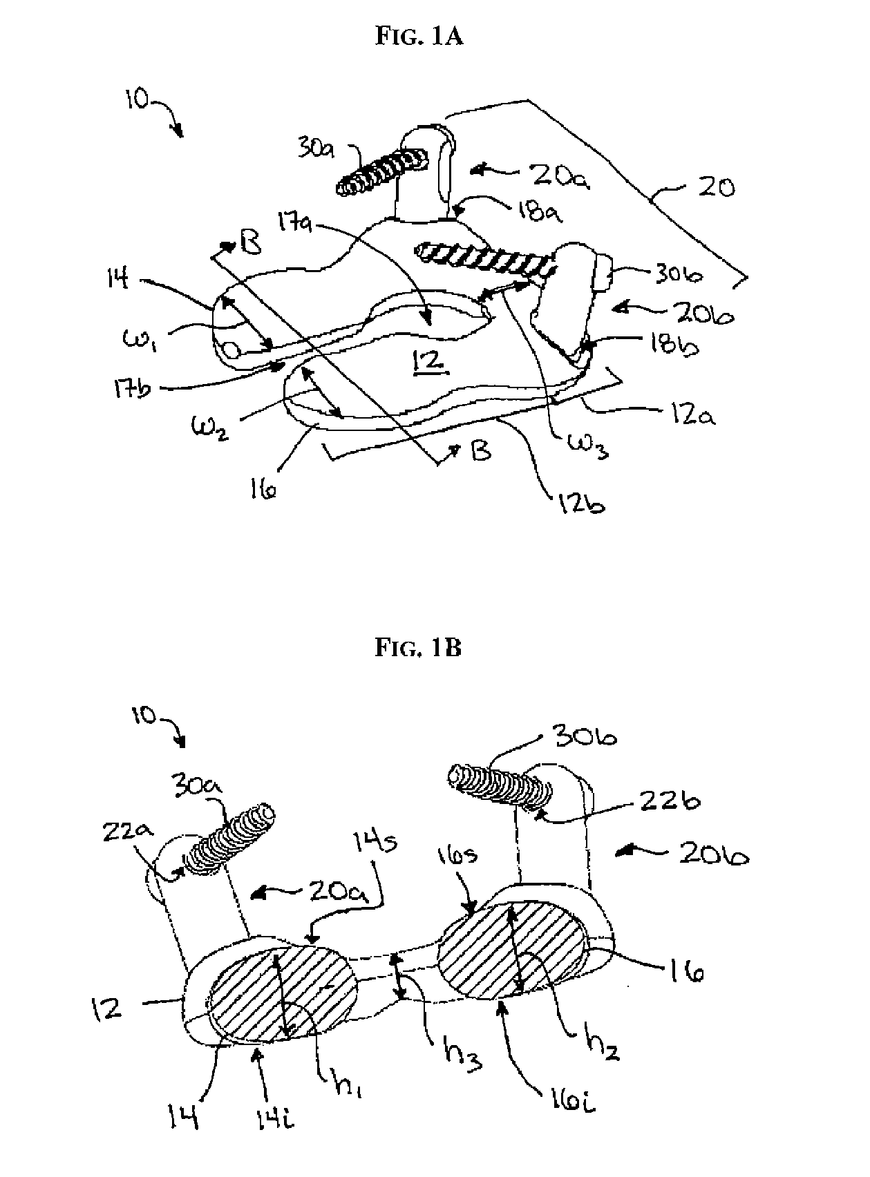 Multi-joint implant