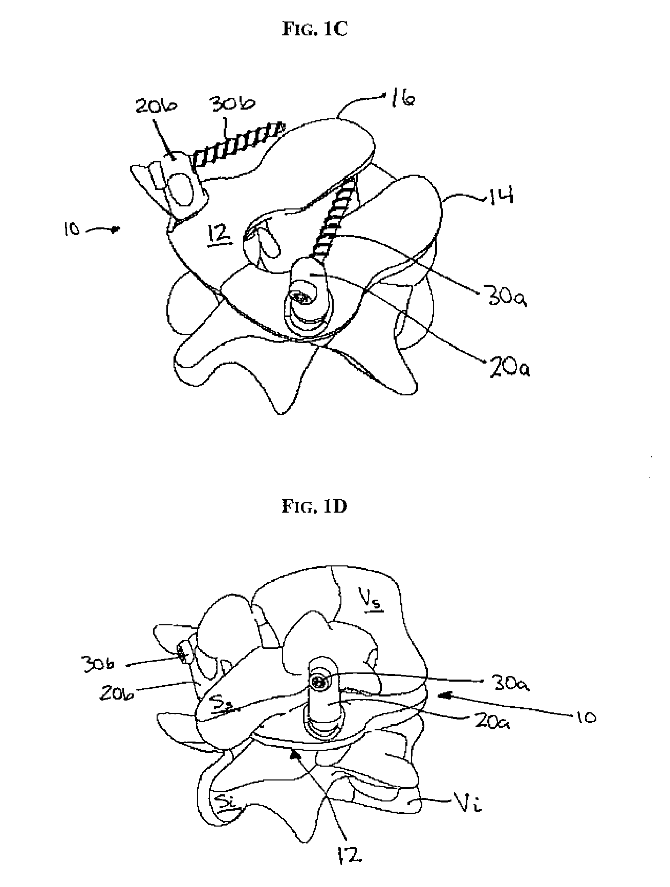 Multi-joint implant