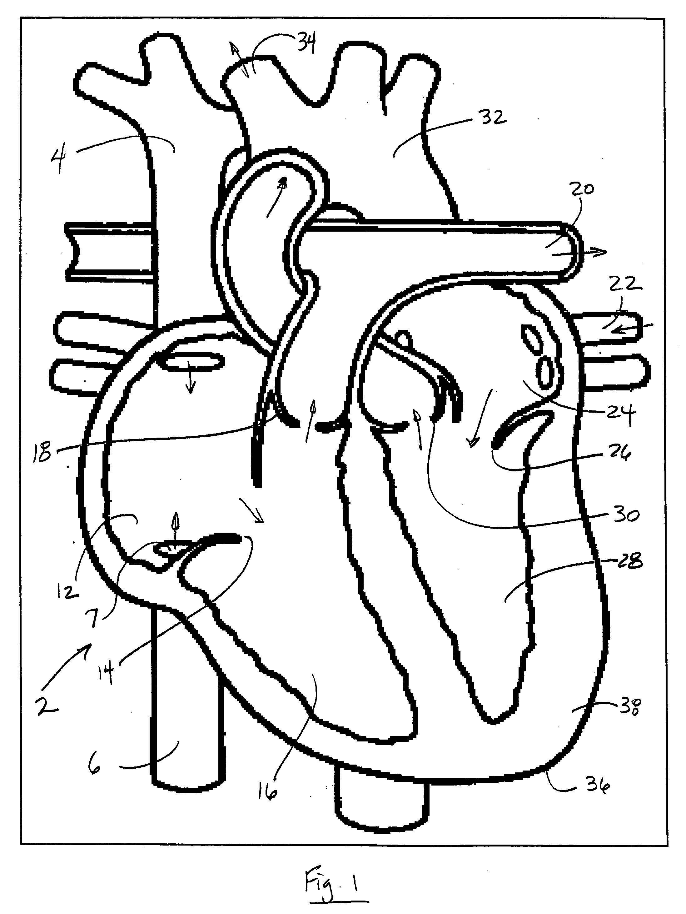 Single expandable double lumen cannula assembly for veno-venous ECMO