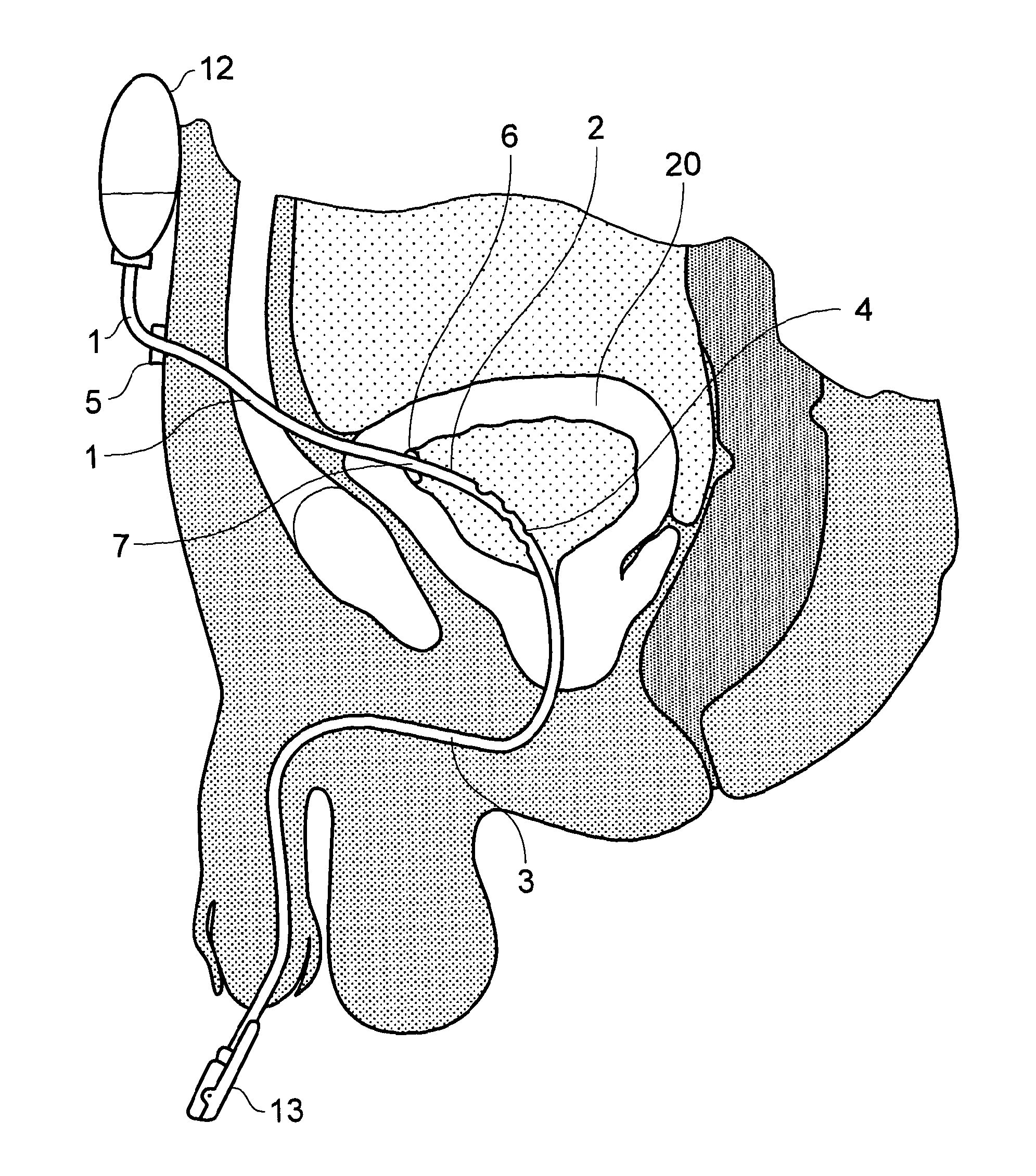 Catheters