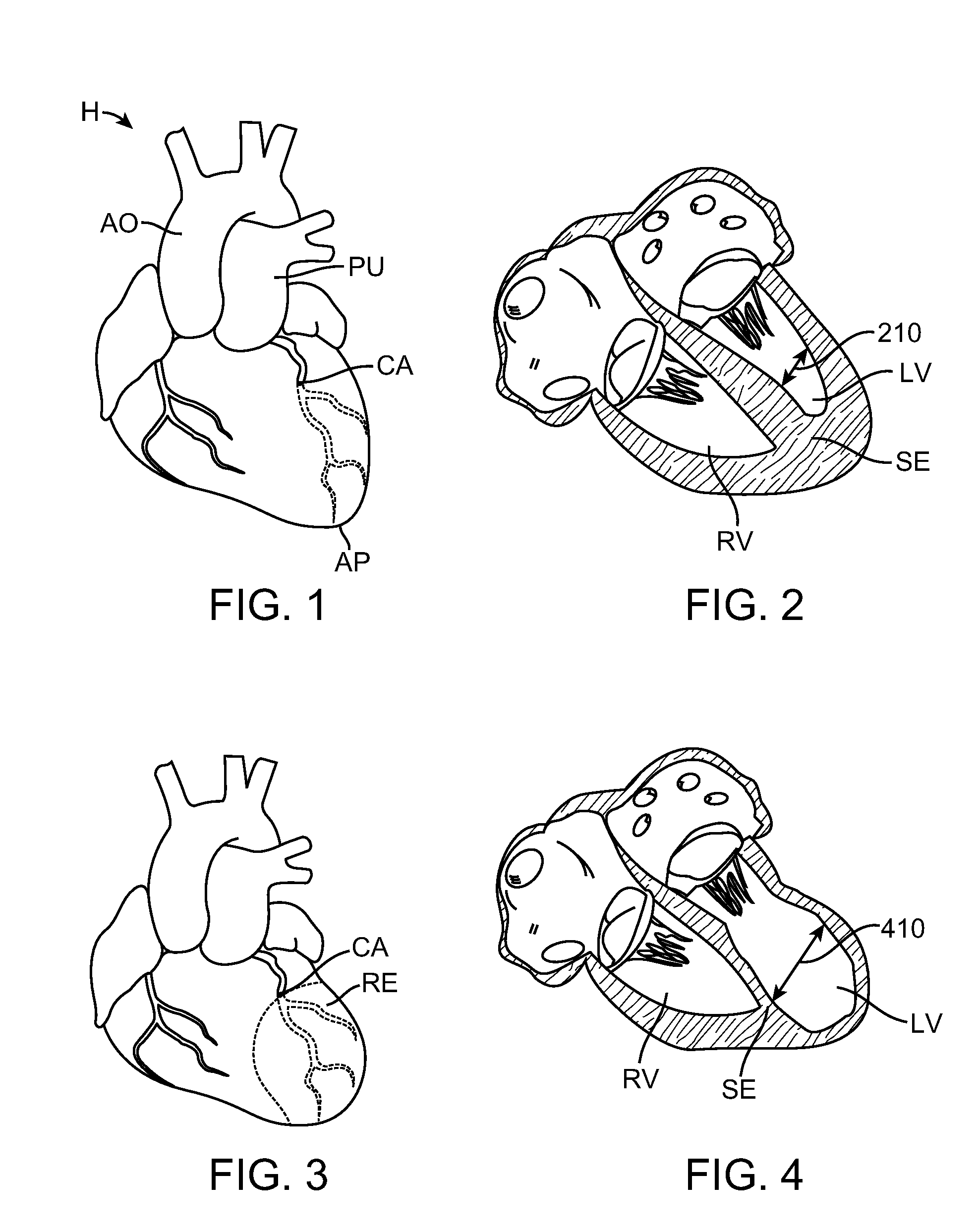 Treating dysfunctional cardiac tissue