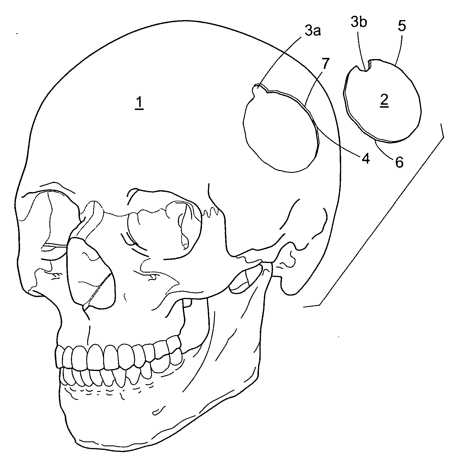 Craniotomy Closures