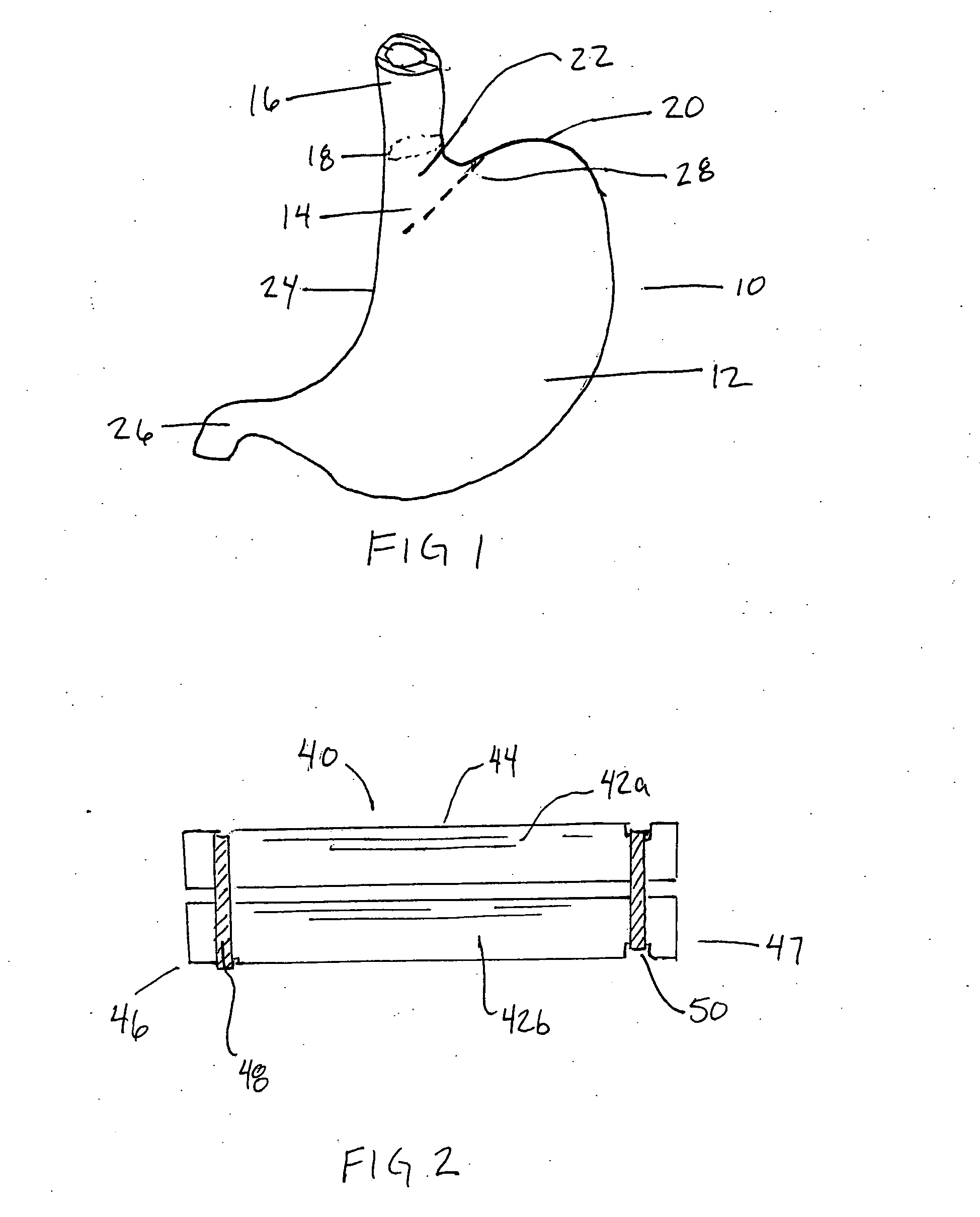 Method and apparatus for partioning an organ within the body