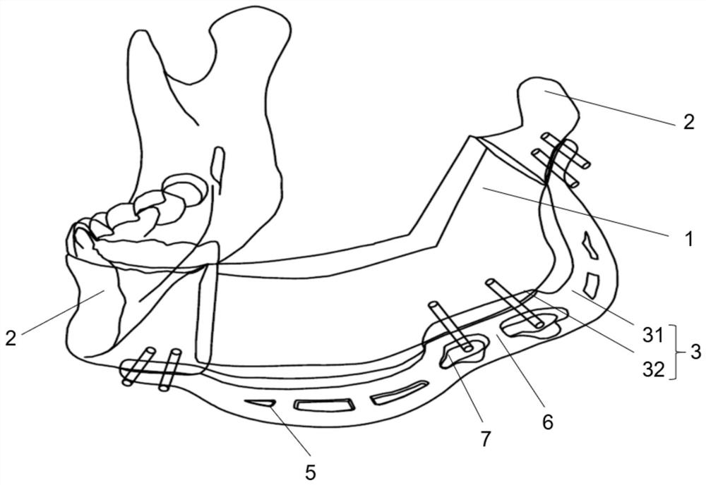 Jaw bone transplantation in-place guide plate