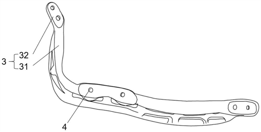 Jaw bone transplantation in-place guide plate