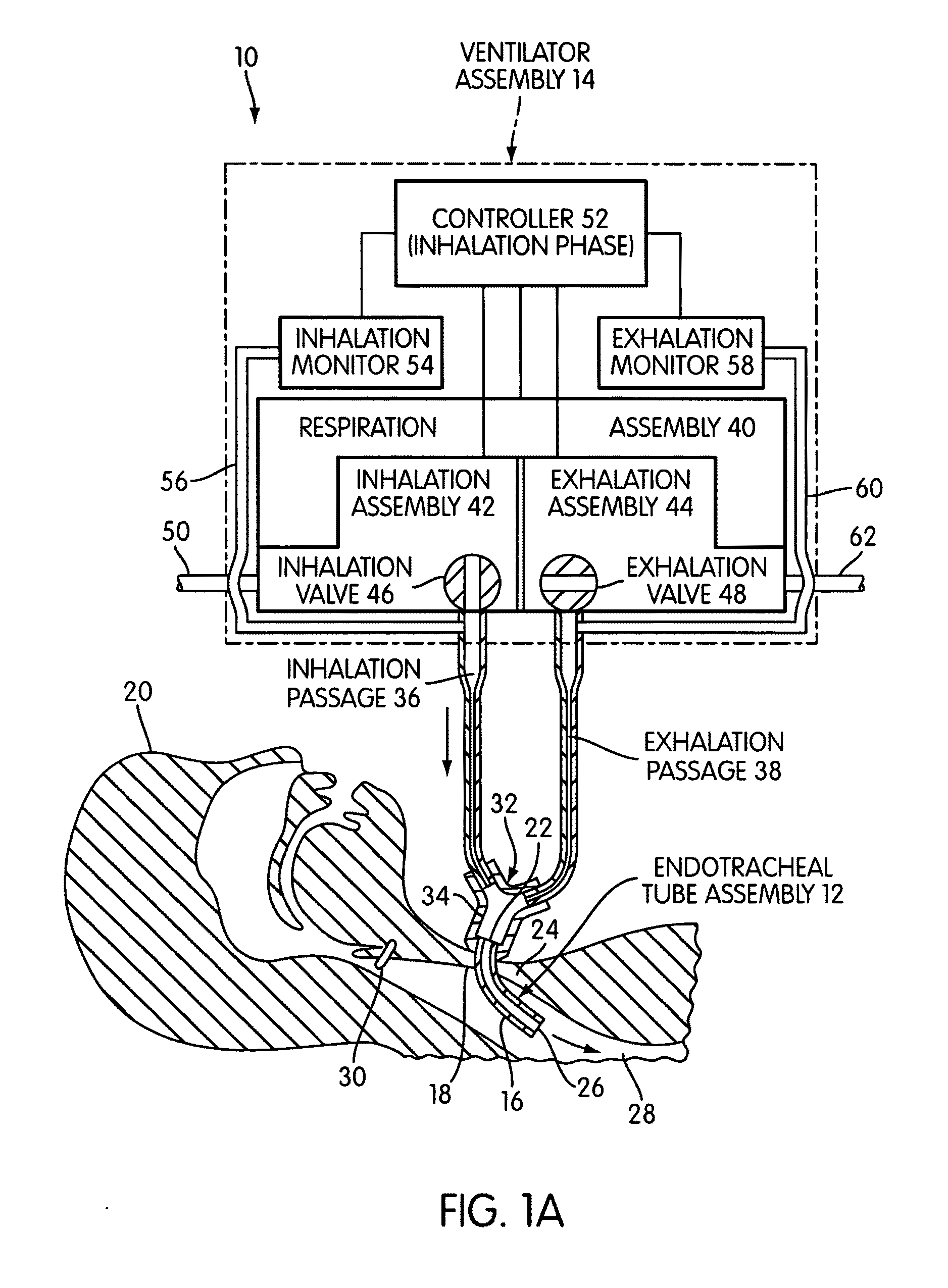 Ventilating apparatus and method enabling a patient to talk with or without a trachostomy tube check valve