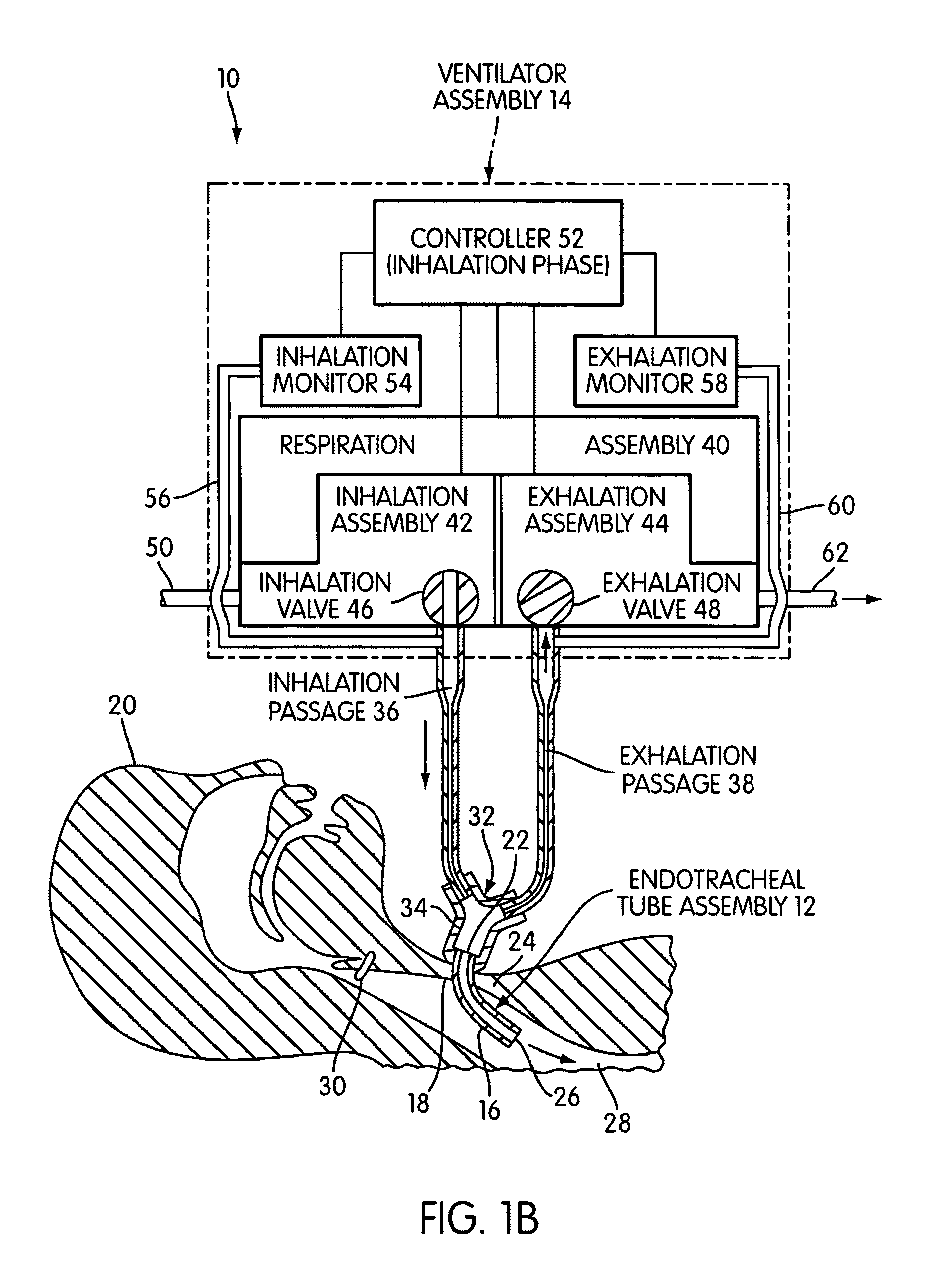 Ventilating apparatus and method enabling a patient to talk with or without a trachostomy tube check valve