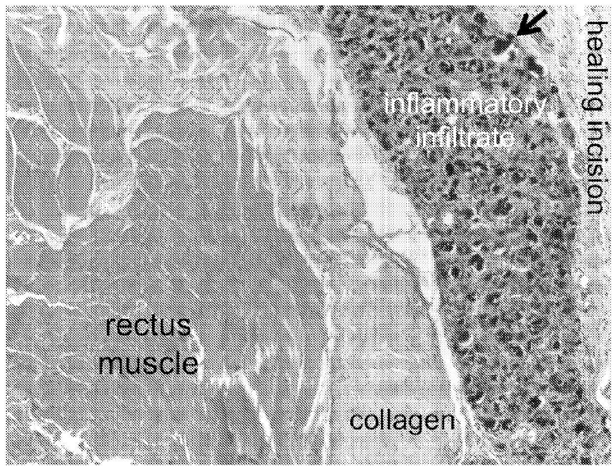 Methods and compositions for treating wounds and reducing the risk of incisional hernias