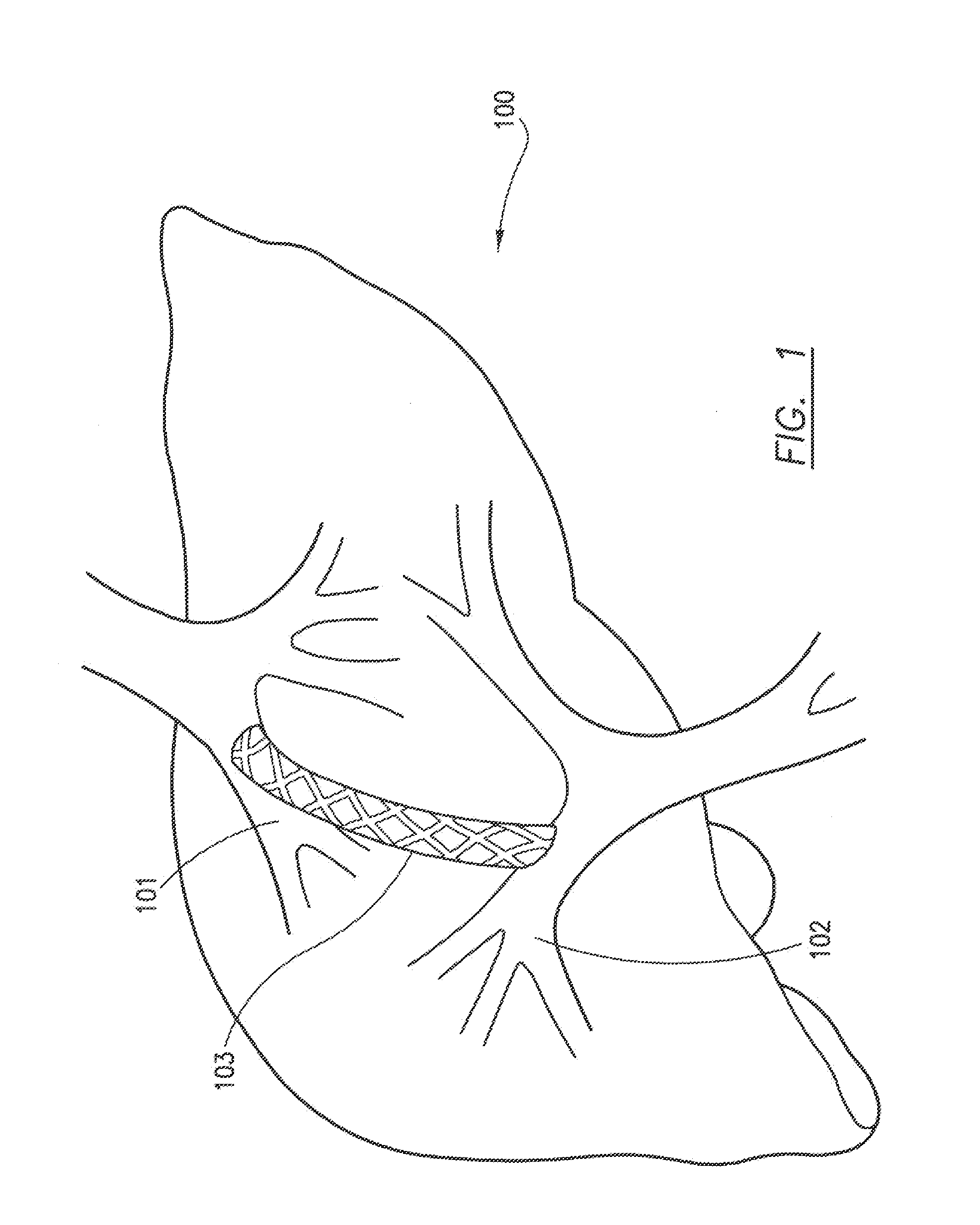 Transjugular intrahepatic portosystemic shunt device