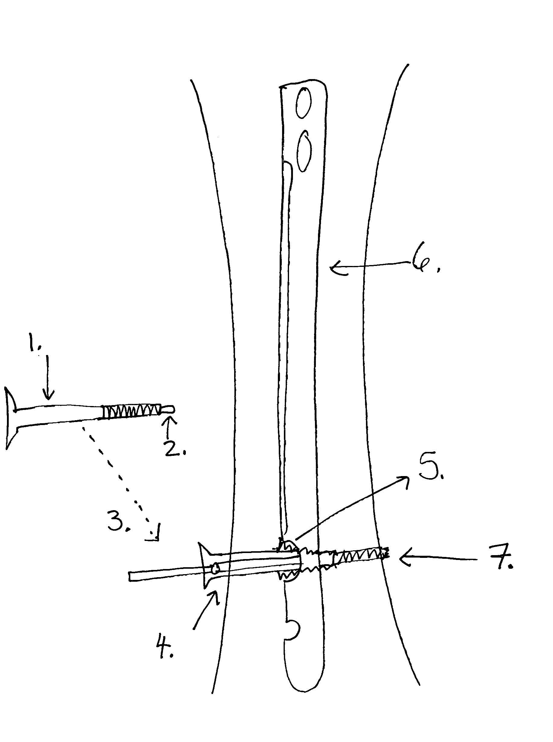 Interlocking IM nails with outer screw