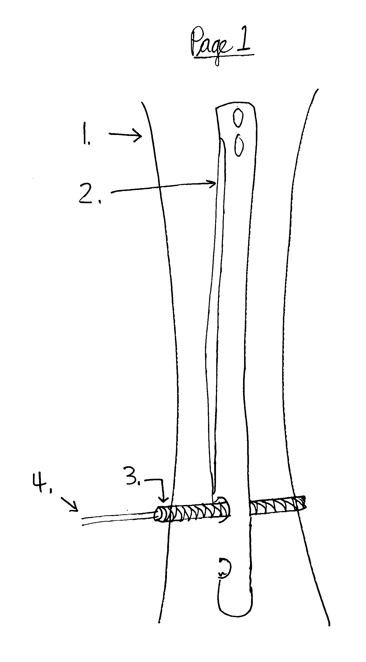 Interlocking IM nails with outer screw