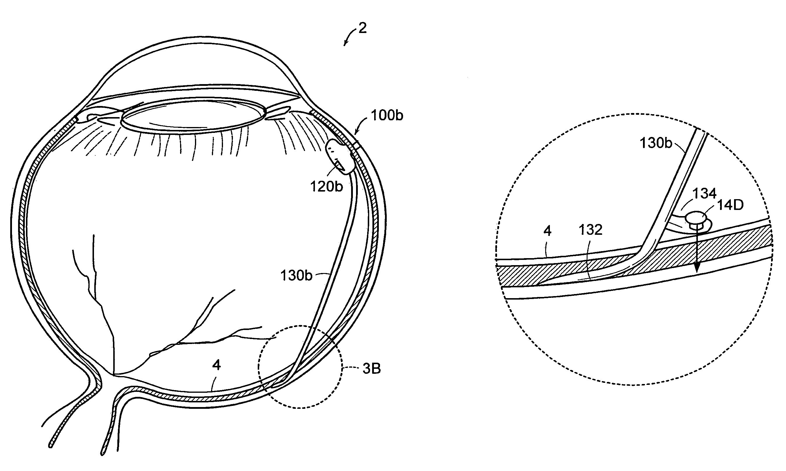 Reservoirs with subretinal cannula for subretinal drug delivery