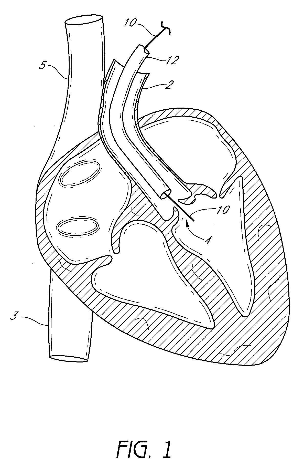 Suturing devices and methods for suturing an anatomic valve