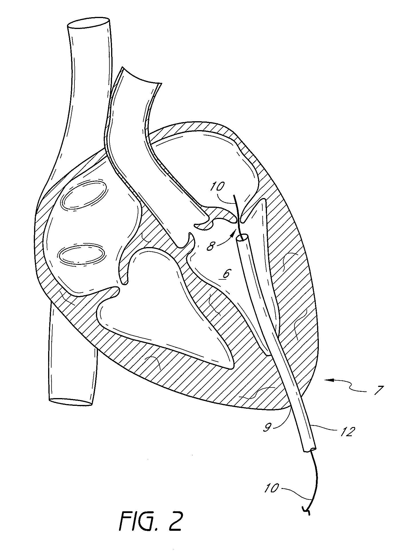 Suturing devices and methods for suturing an anatomic valve