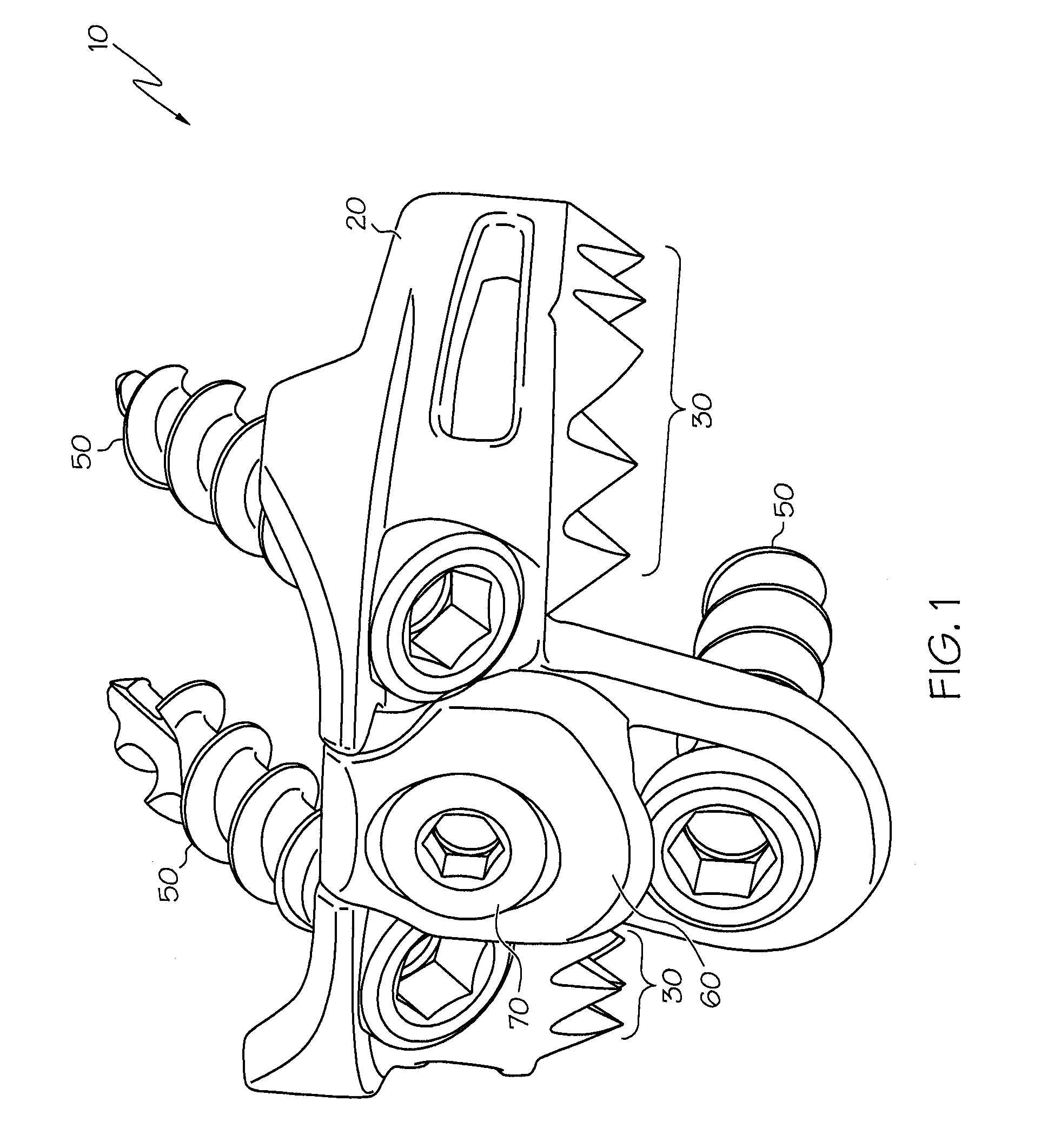 Implant subsidence control