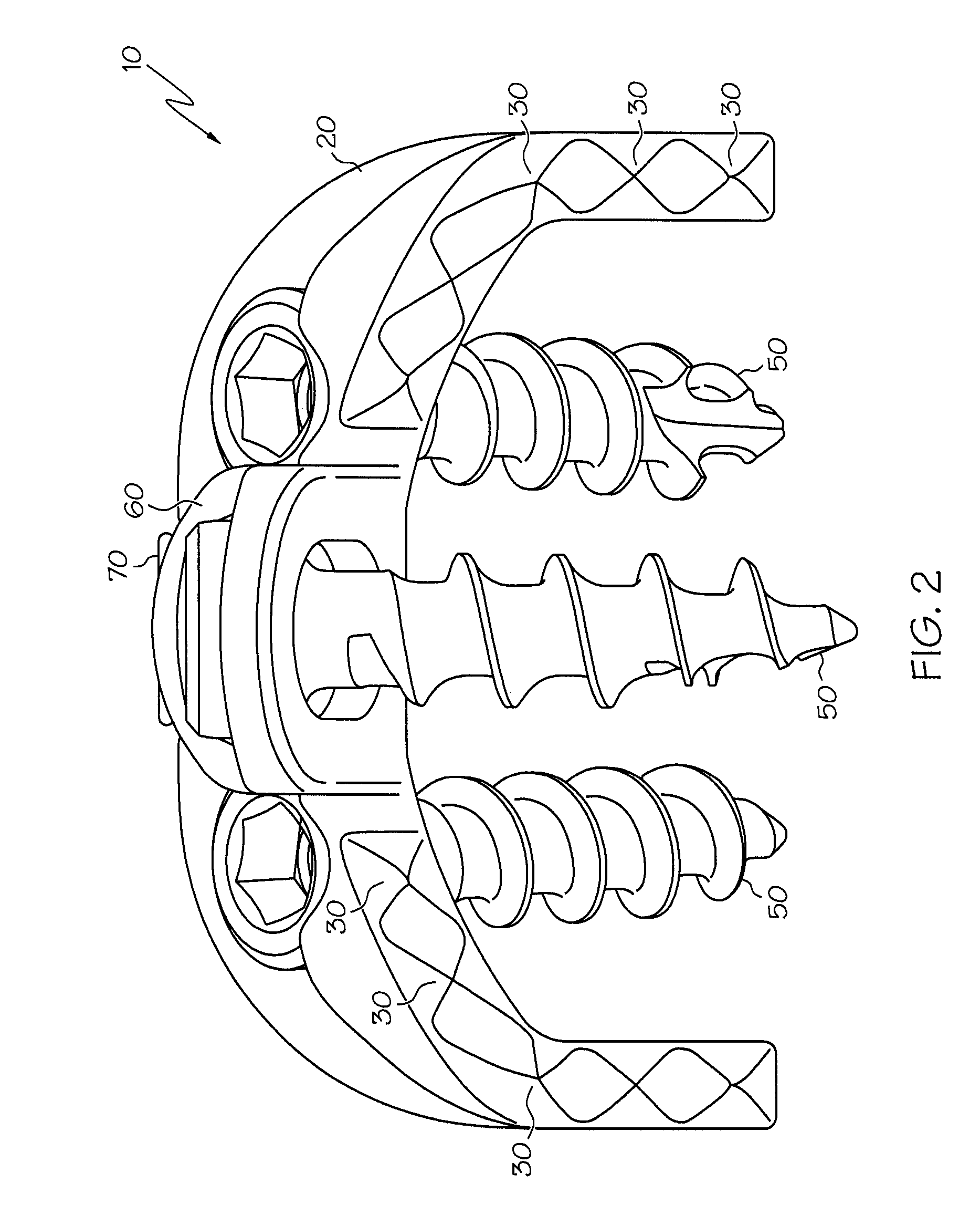 Implant subsidence control