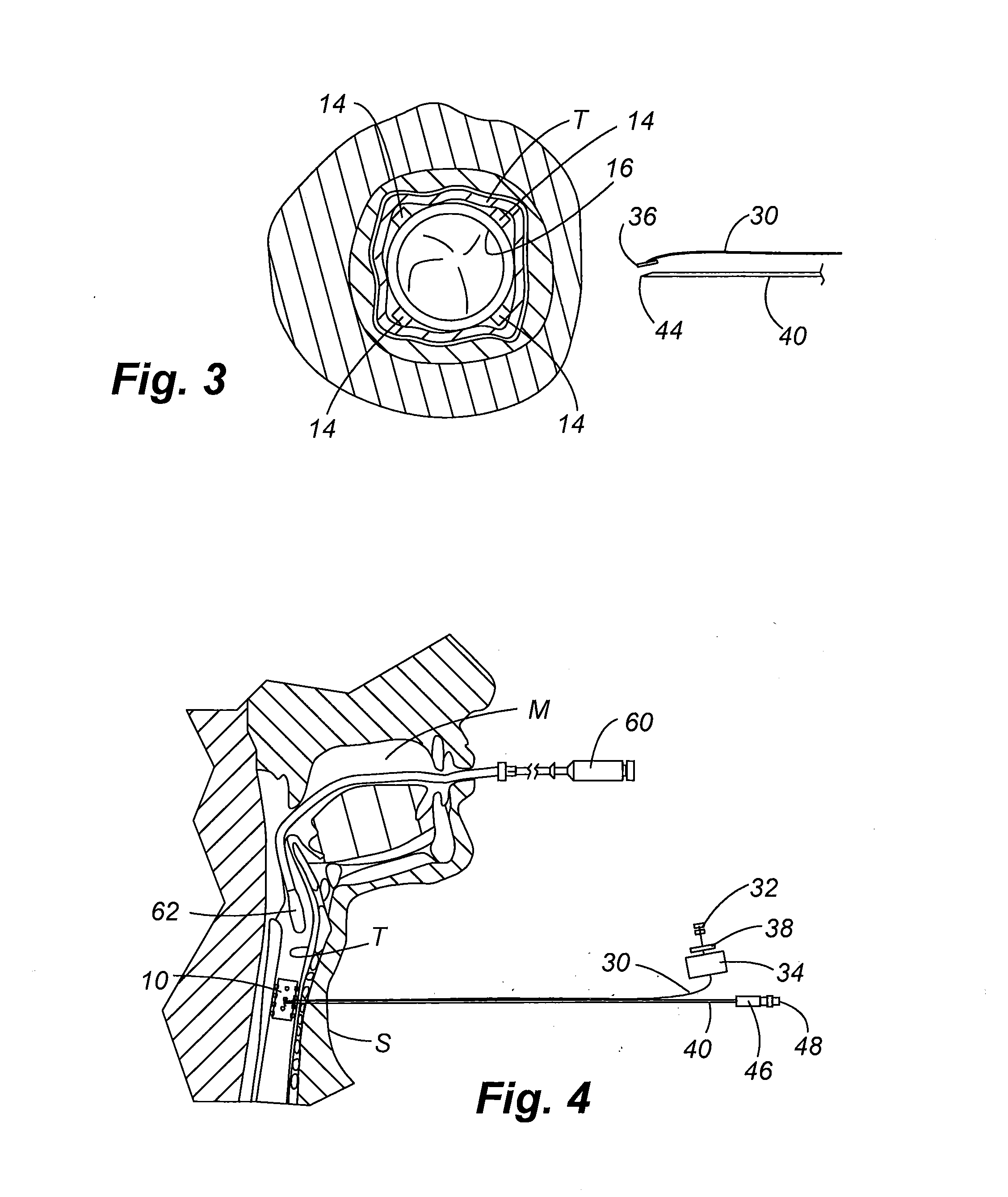 Airway anchor suture to prevent airway stent migration