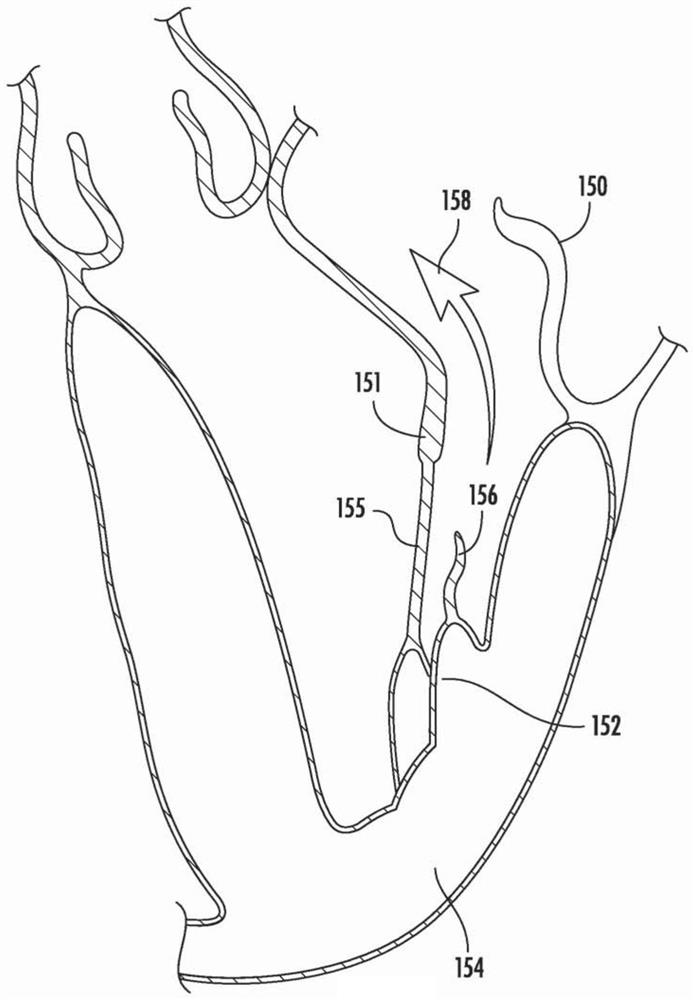 Devices, systems, and methods for adjustably tensioning an artificial chordae tendineae between a leaflet and a papillary muscle or heart wall