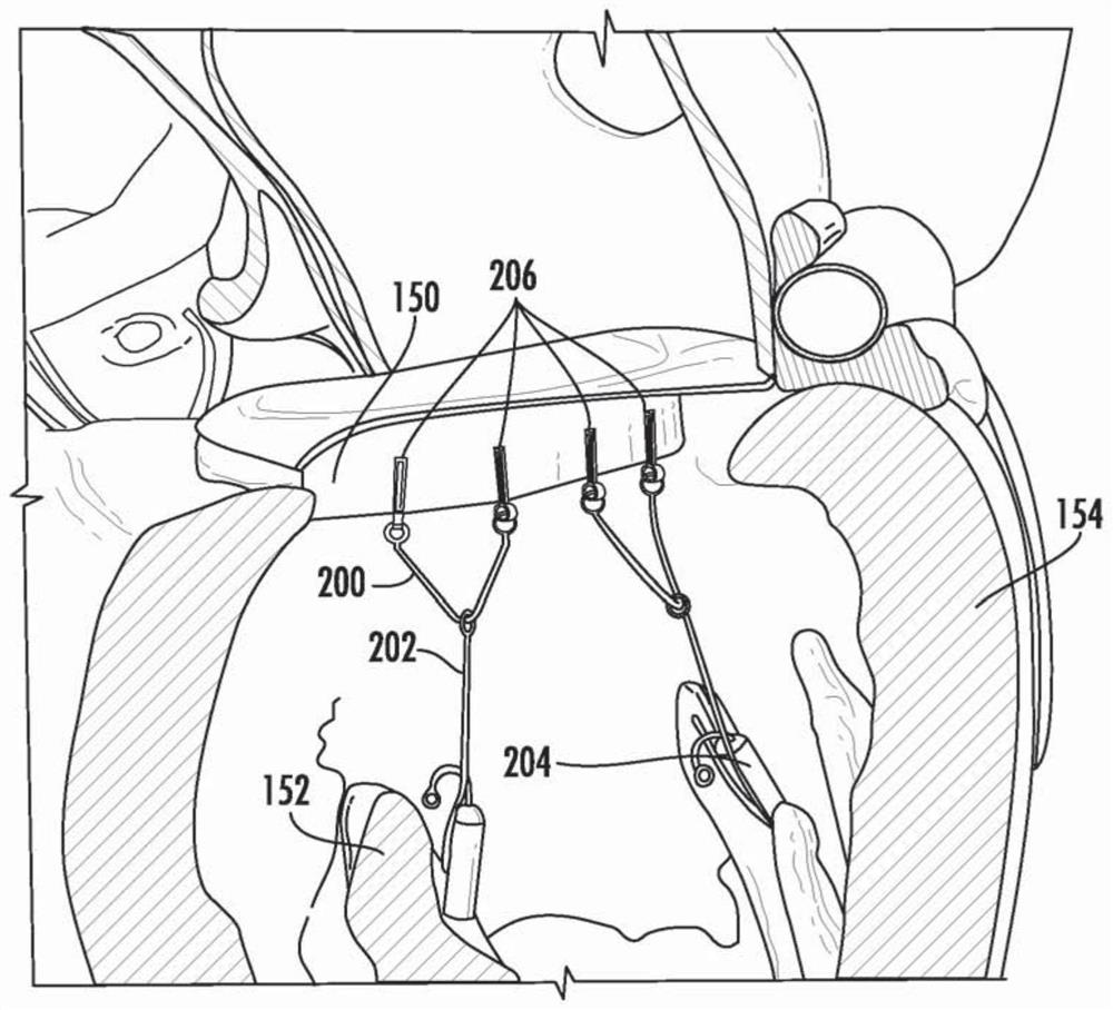 Devices, systems, and methods for adjustably tensioning an artificial chordae tendineae between a leaflet and a papillary muscle or heart wall