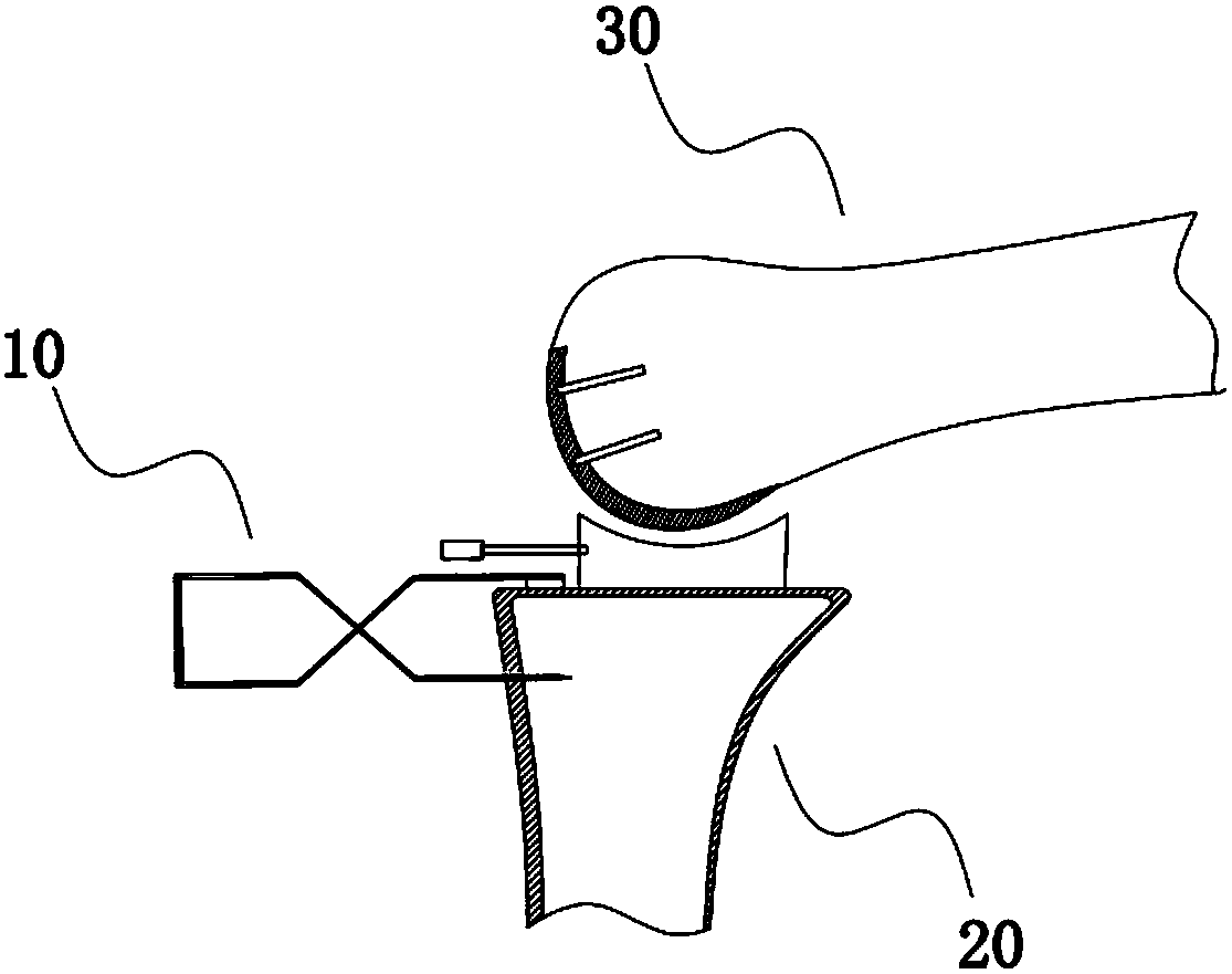 Tibial prothesis anti-shift fixator for unicompartmental knee arthroplasty