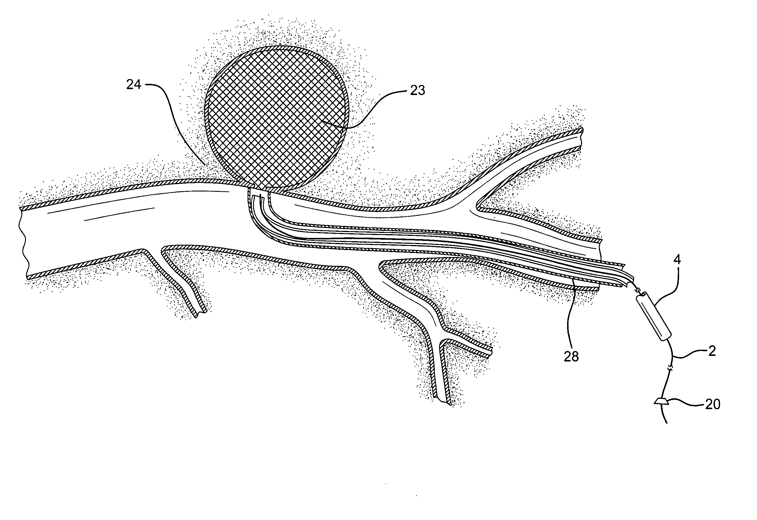 Endovascular device and clotting system for the repair of vascular defects and malformations