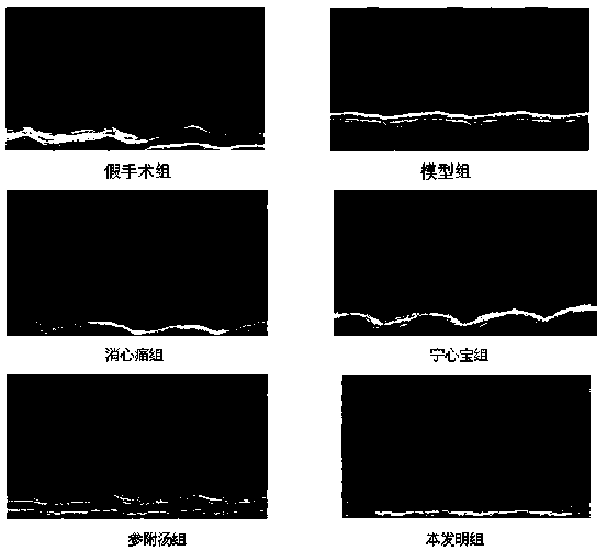 Traditional Chinese medicine composition for treating coronary heart disease yang deficiency and blood stagnation and blood vessel stasis diseases