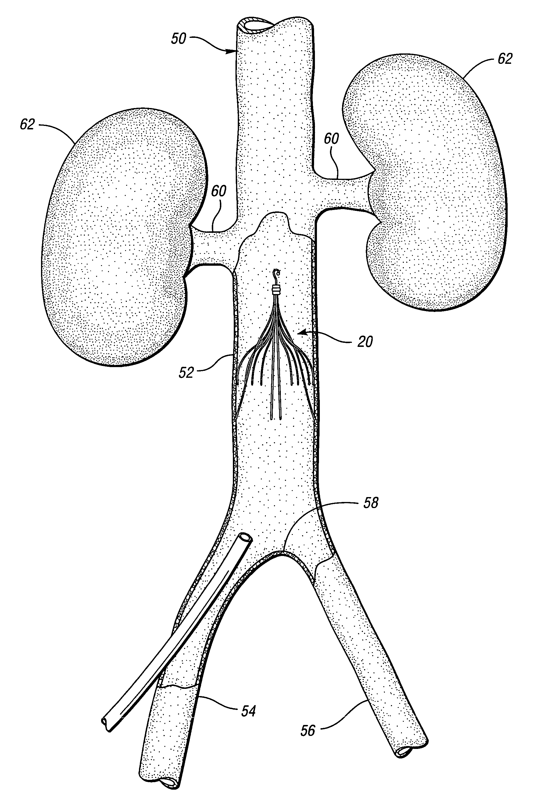 Removable vena cava filter for reduced trauma in collapsed configuration