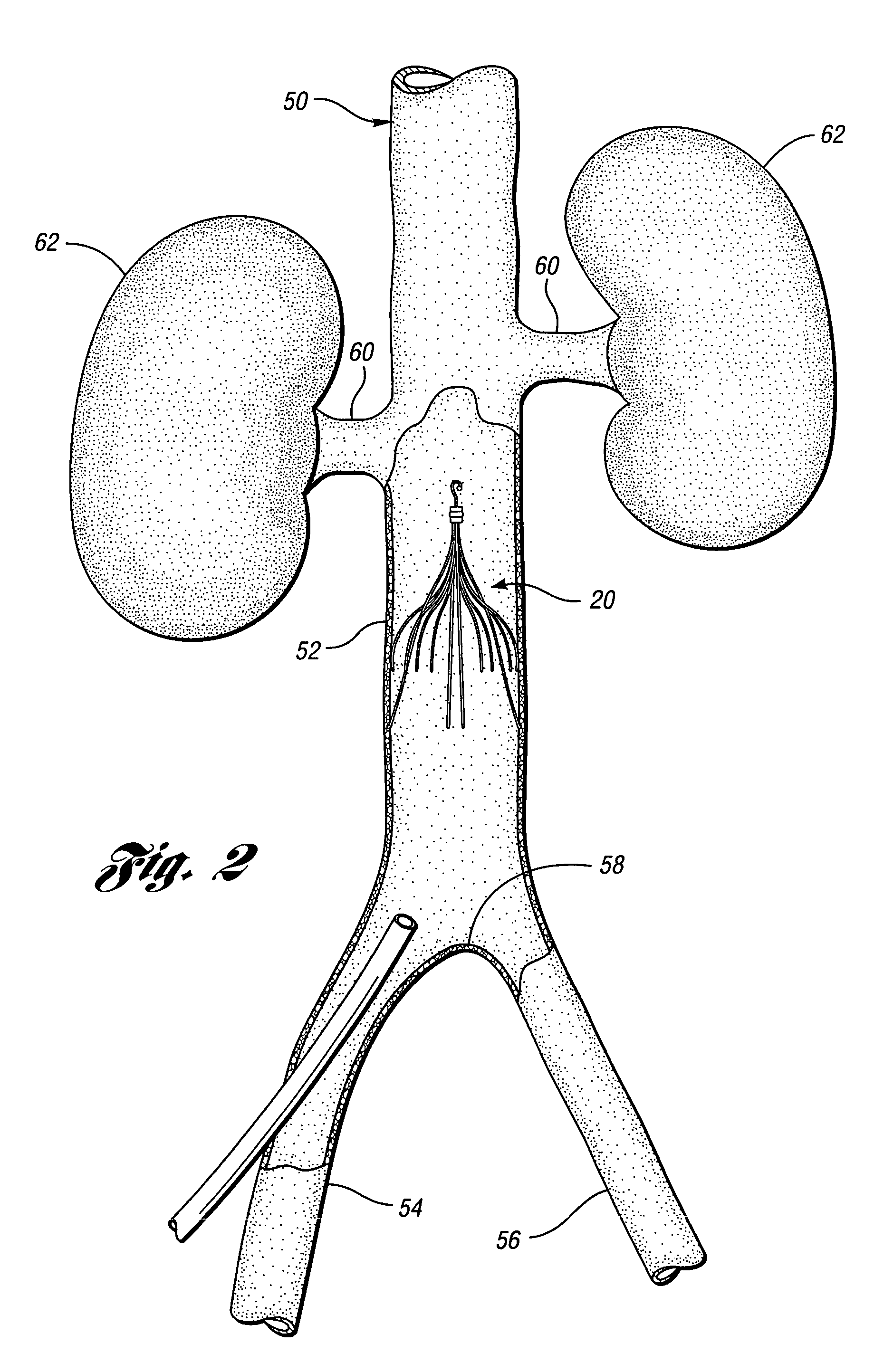 Removable vena cava filter for reduced trauma in collapsed configuration