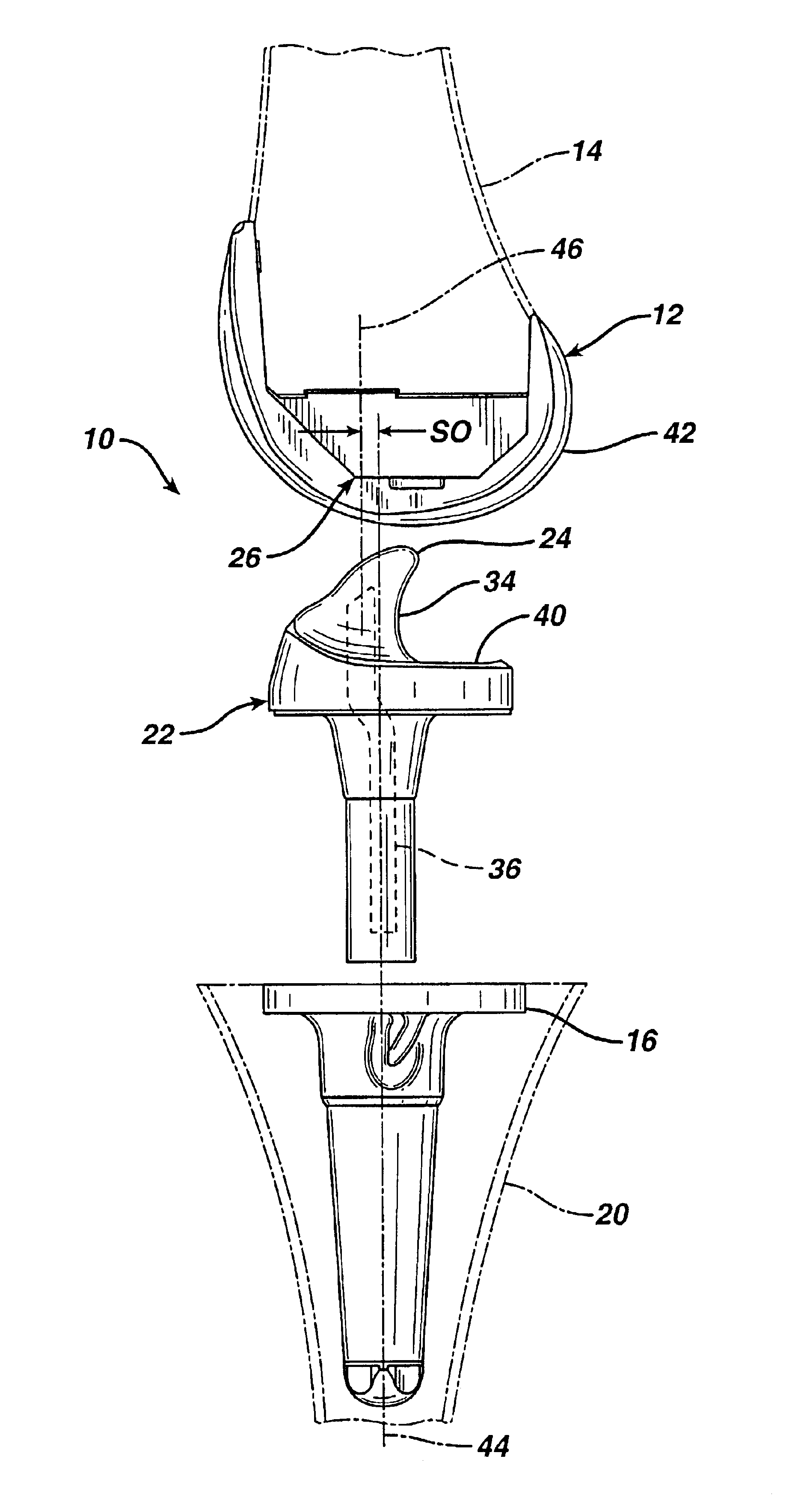 Joint replacement prosthesis component with non linear insert