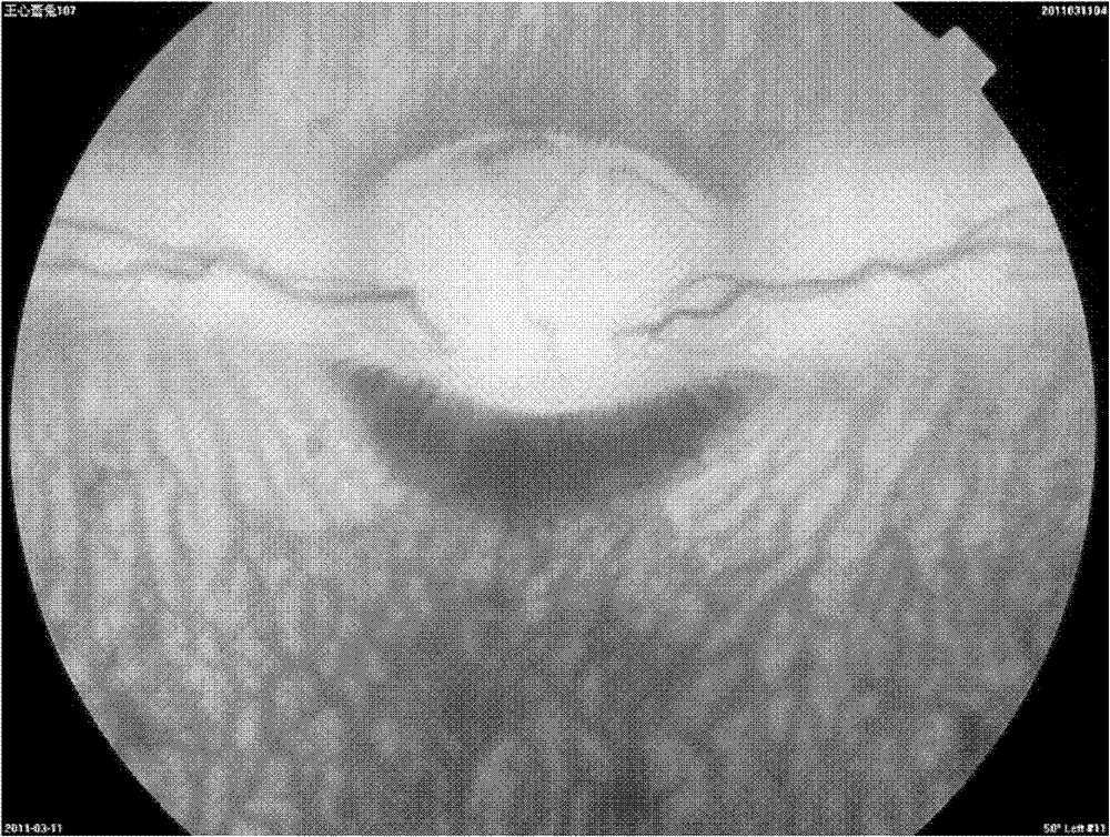 In-situ crosslinked hydrogel for intraocular tamponade, and preparation method and application thereof