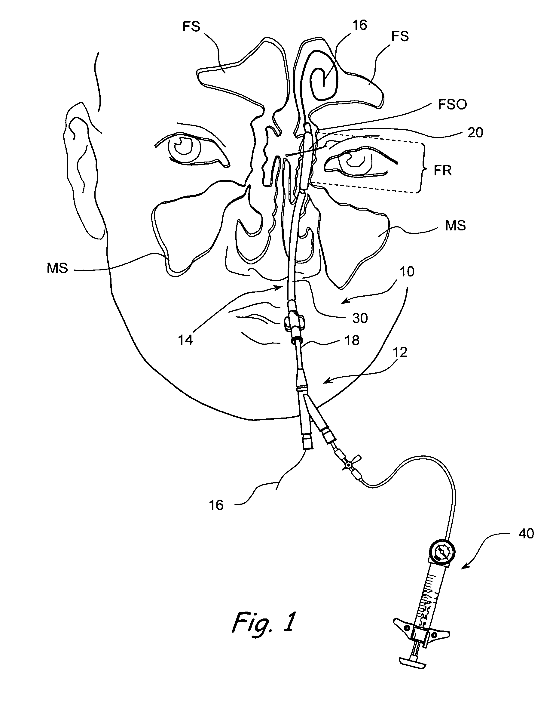 Devices, systems and methods useable for treating frontal sinusitis