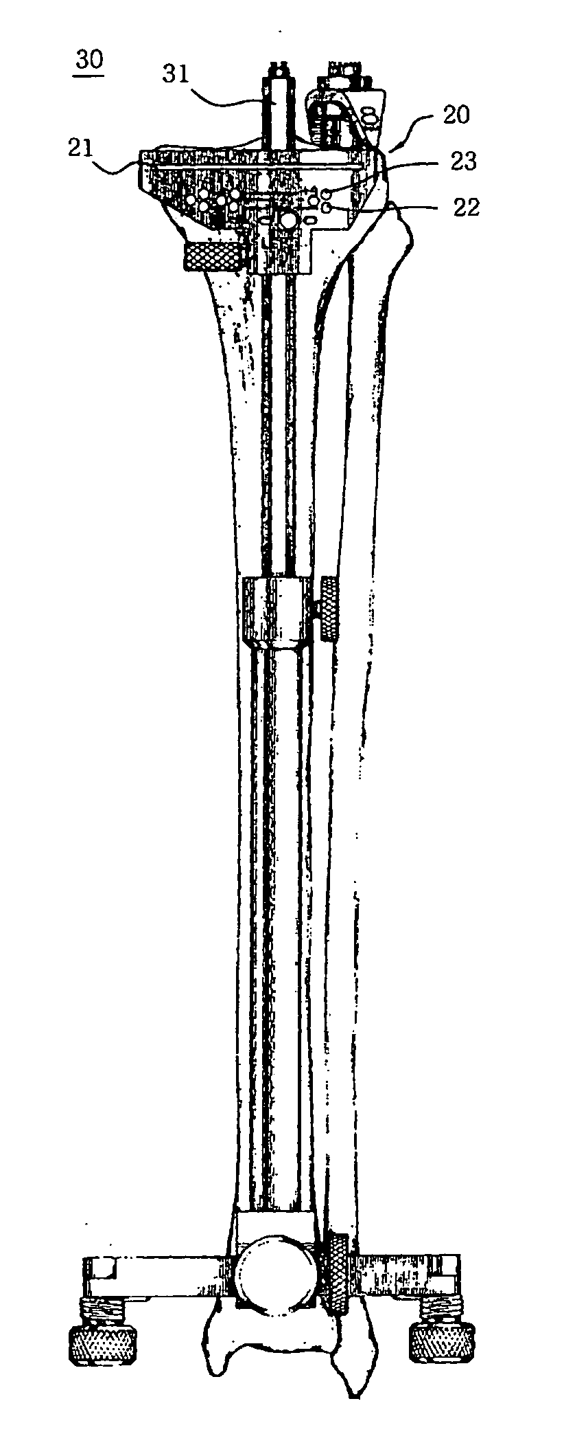 Tibia cutter