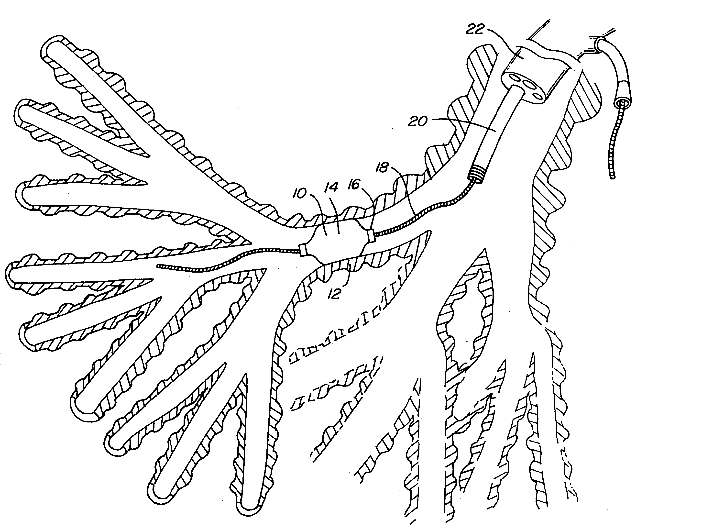 Method of compressing a portion of a lung