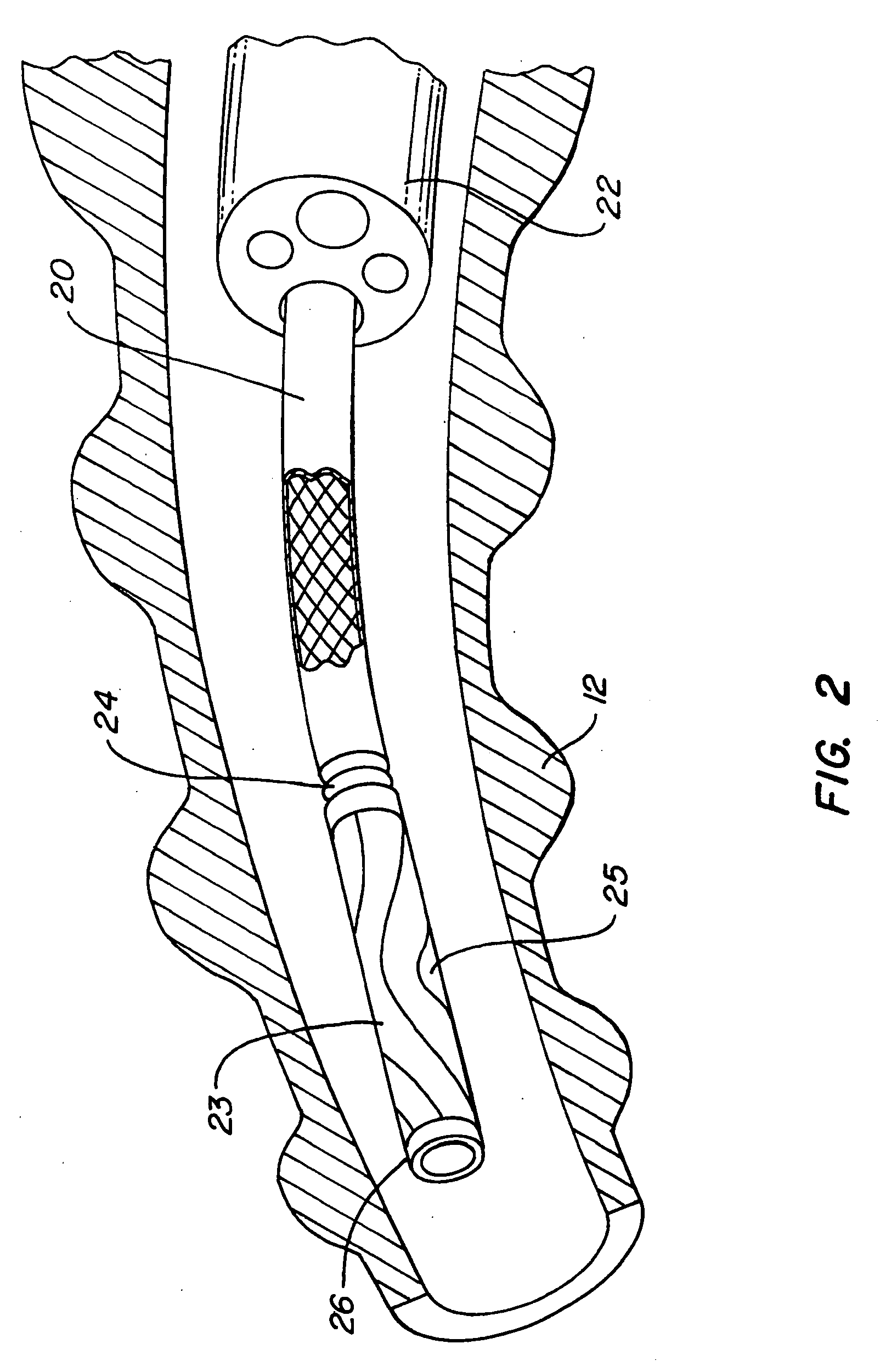 Method of compressing a portion of a lung