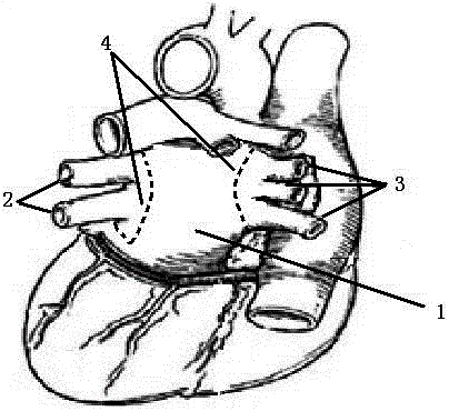 Chemical ablation device for treating arrhythmia