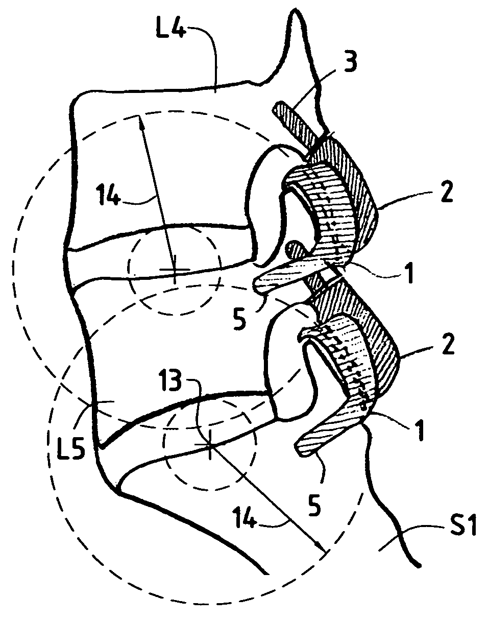 Posterior vertebral joint prosthesis