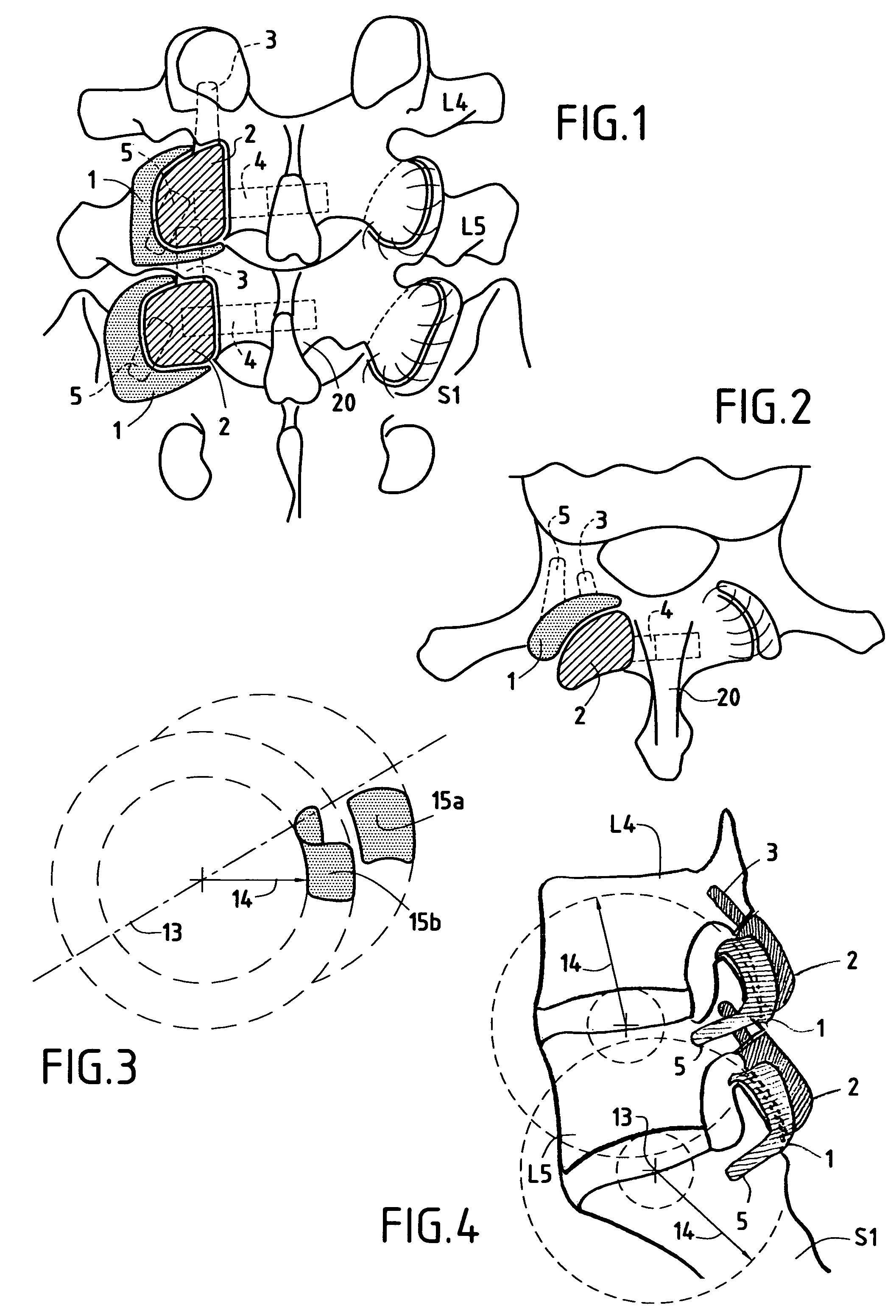 Posterior vertebral joint prosthesis