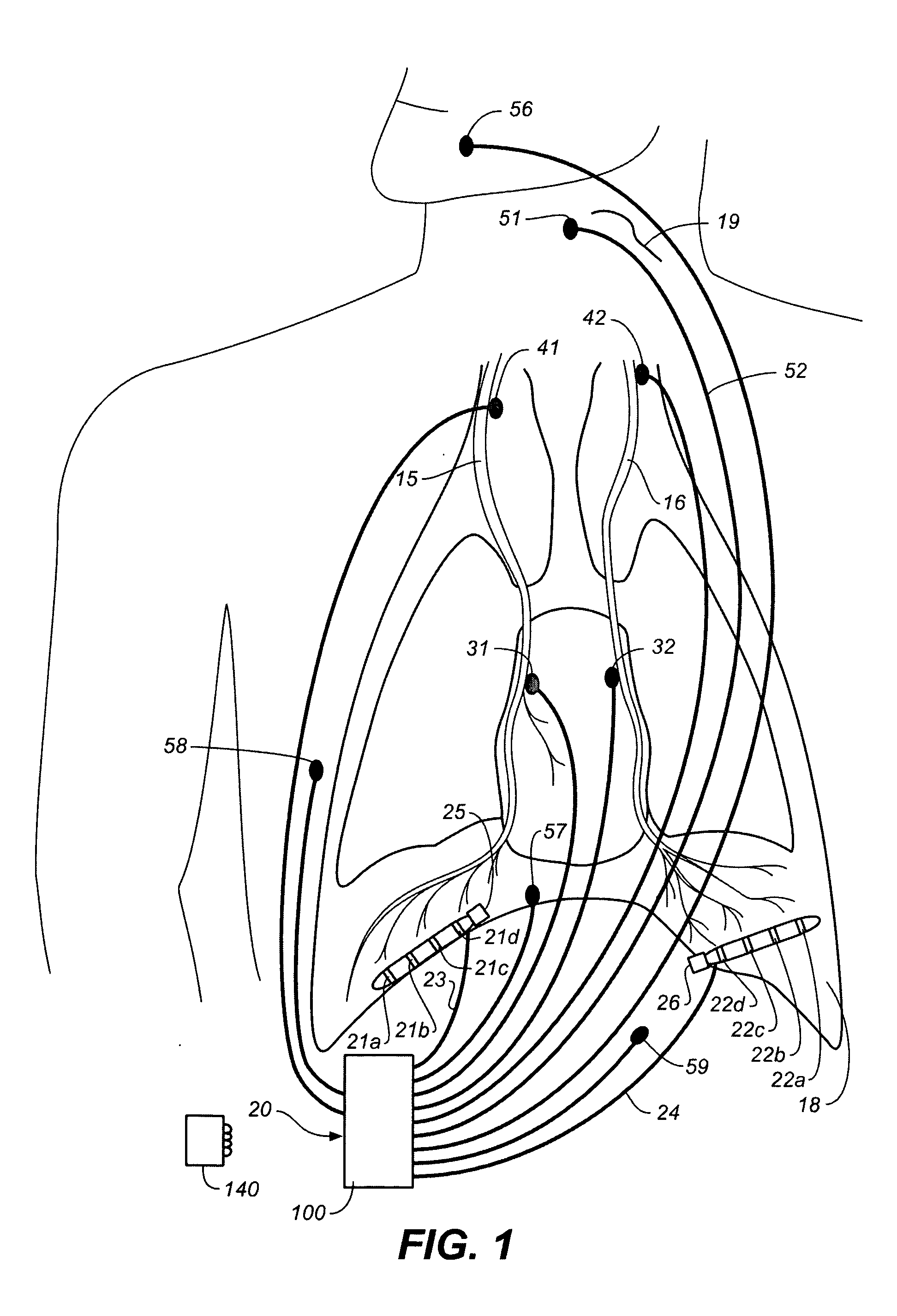 Therapeutic diaphragm stimulation device and method