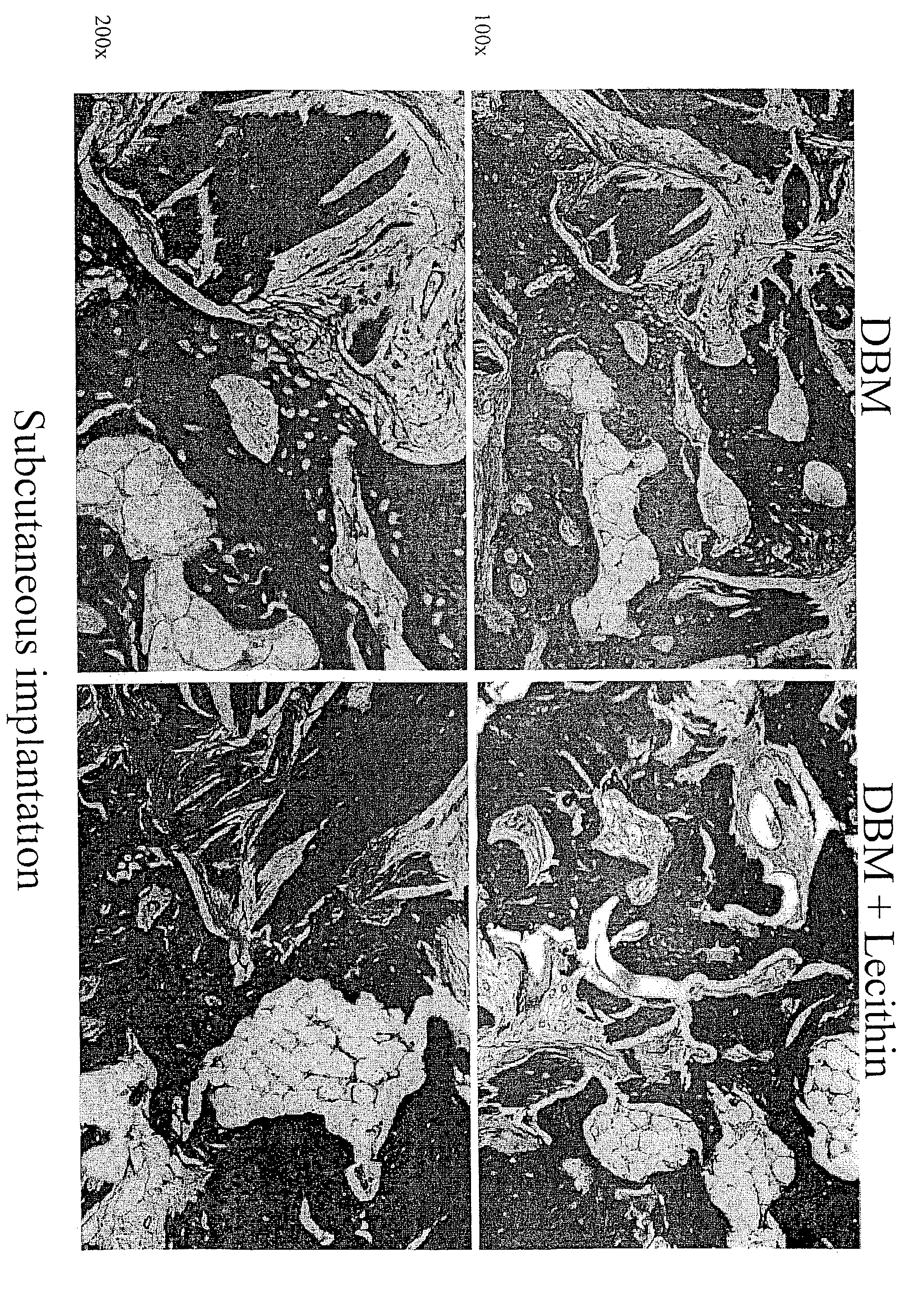 Bone graft material incorporating demineralized bone matrix and lipids